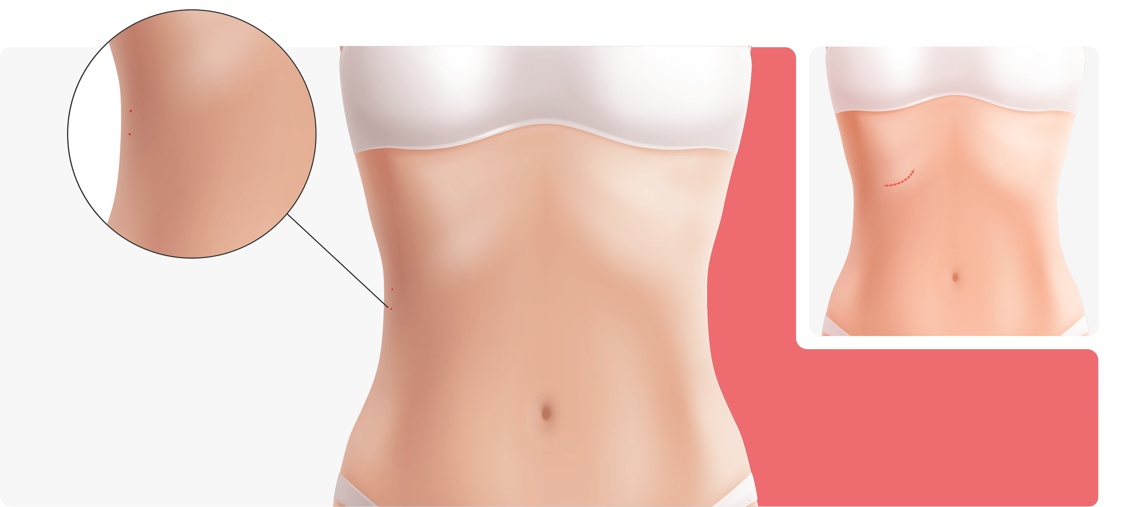 Angular waist infolding and rib resection comparison illustration