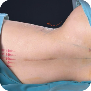 Softening Angular Waist Infolding