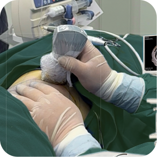 Angular Waist Infolding & Fixation