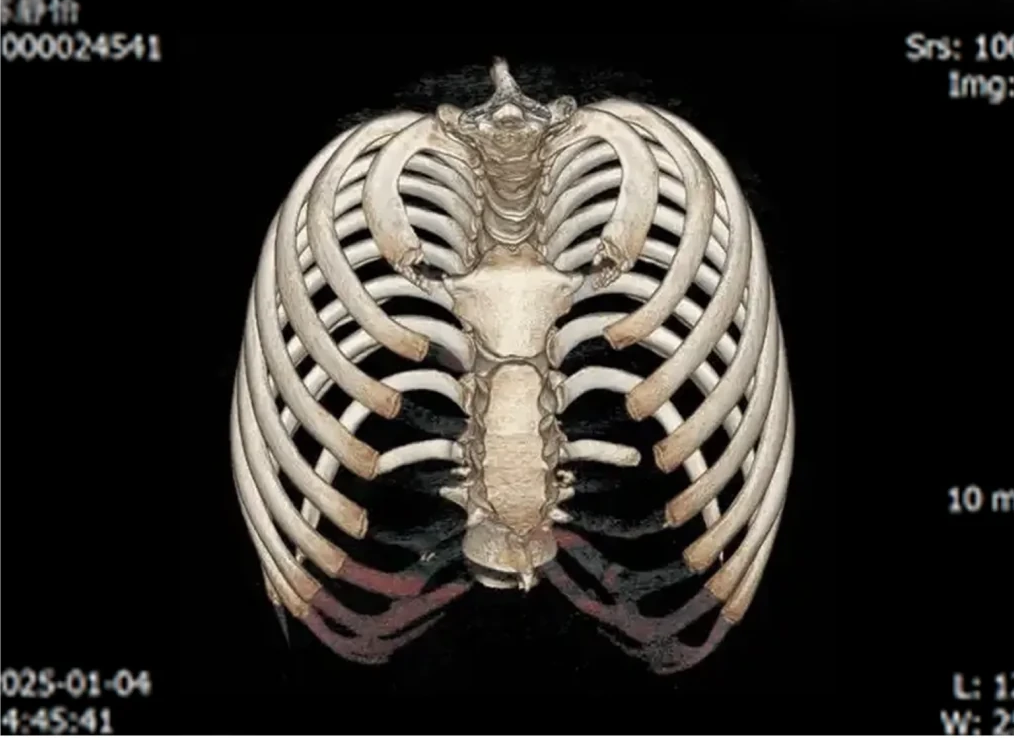3D ribcage digital design CT model
