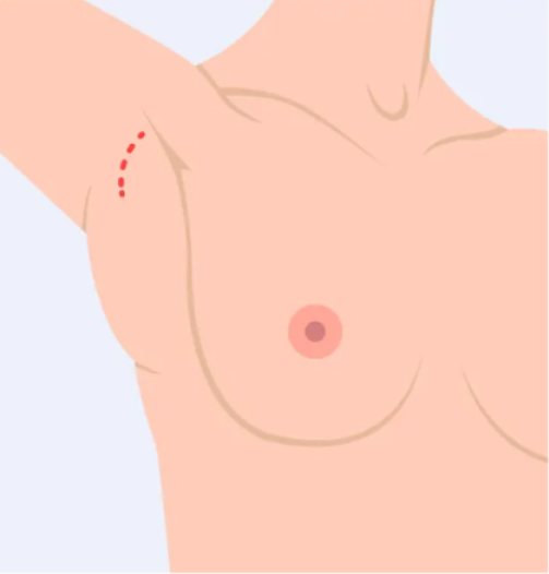 Axillary Incision