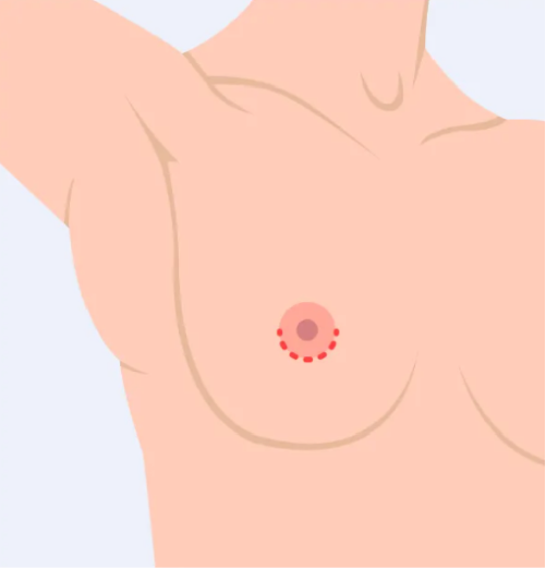 Periareolar Incision
