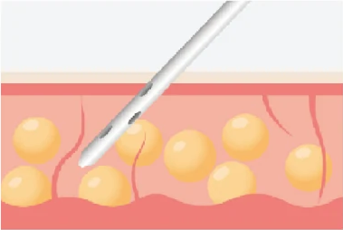 Negative Pressure
Liposuction