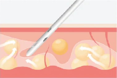 Water-Assisted Liposuction