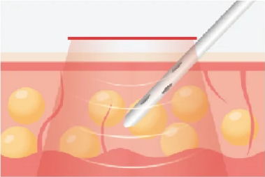 Radiofrequency (RF)
Liposuction