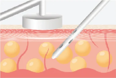 Ultrasound-Assisted
Liposuction