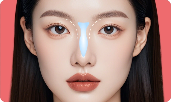 Double-C support rhinoplasty