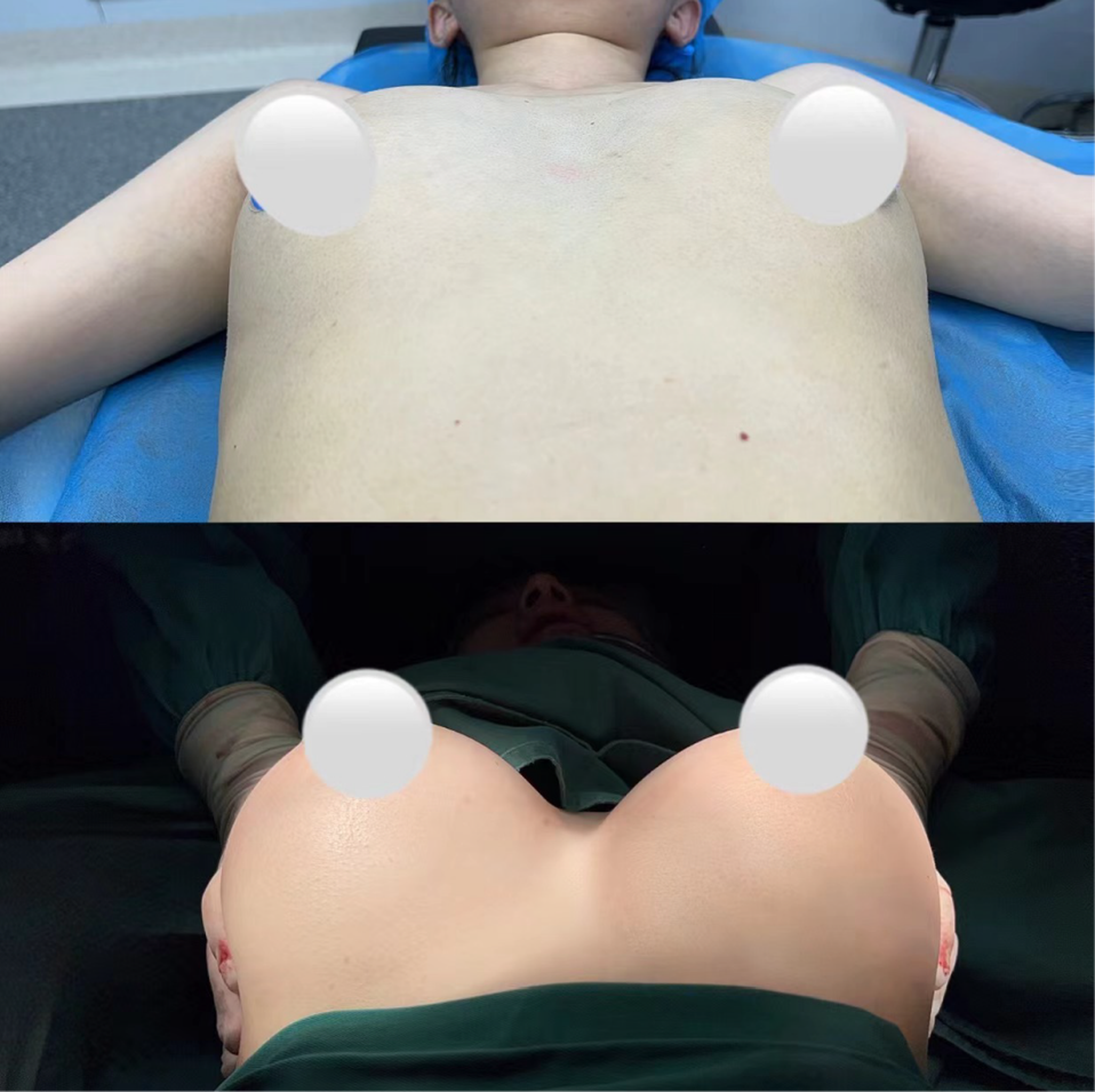 Chest implant augmentation case 1 before and after