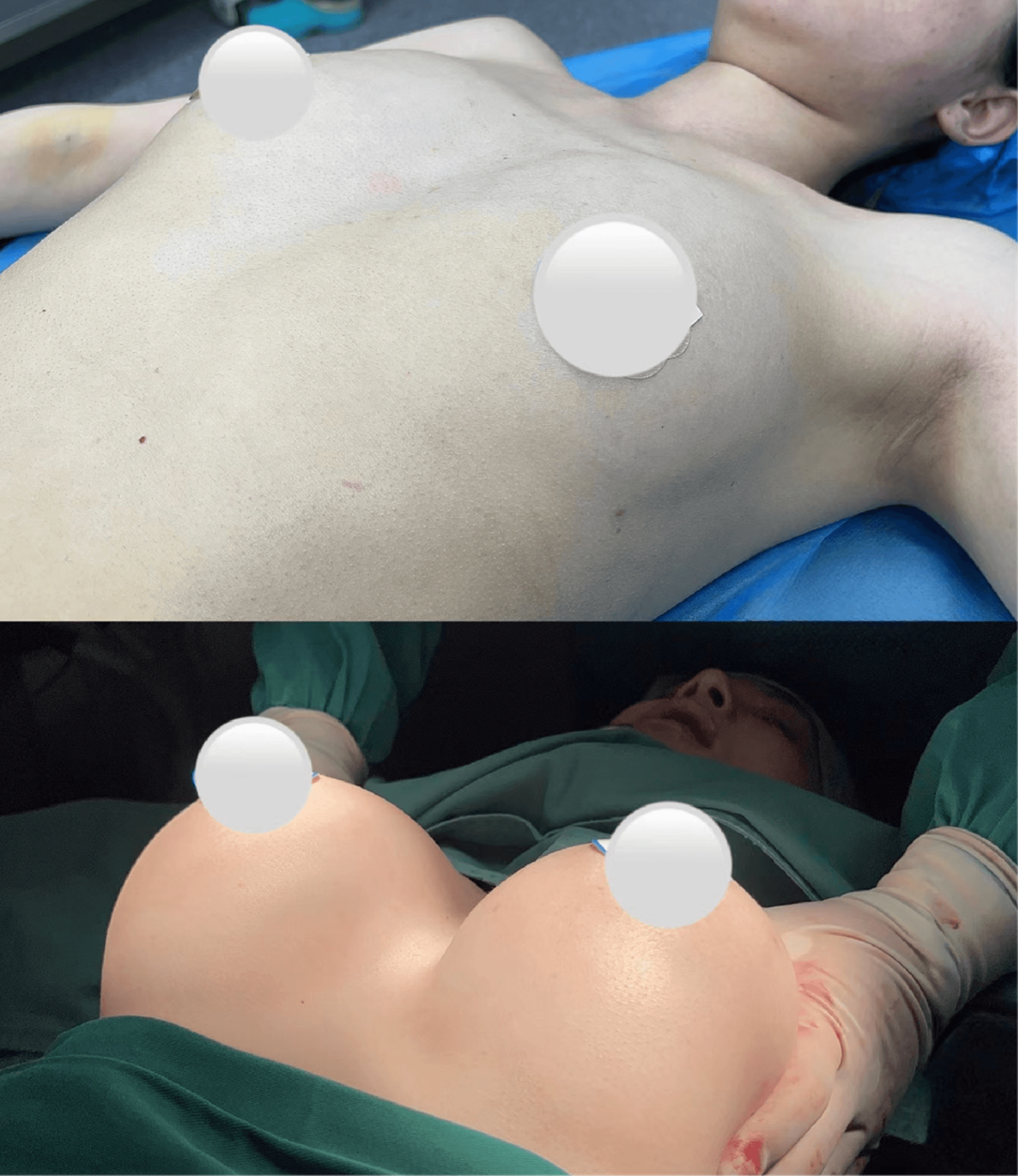 Chest implant augmentation case 1 additional before and after