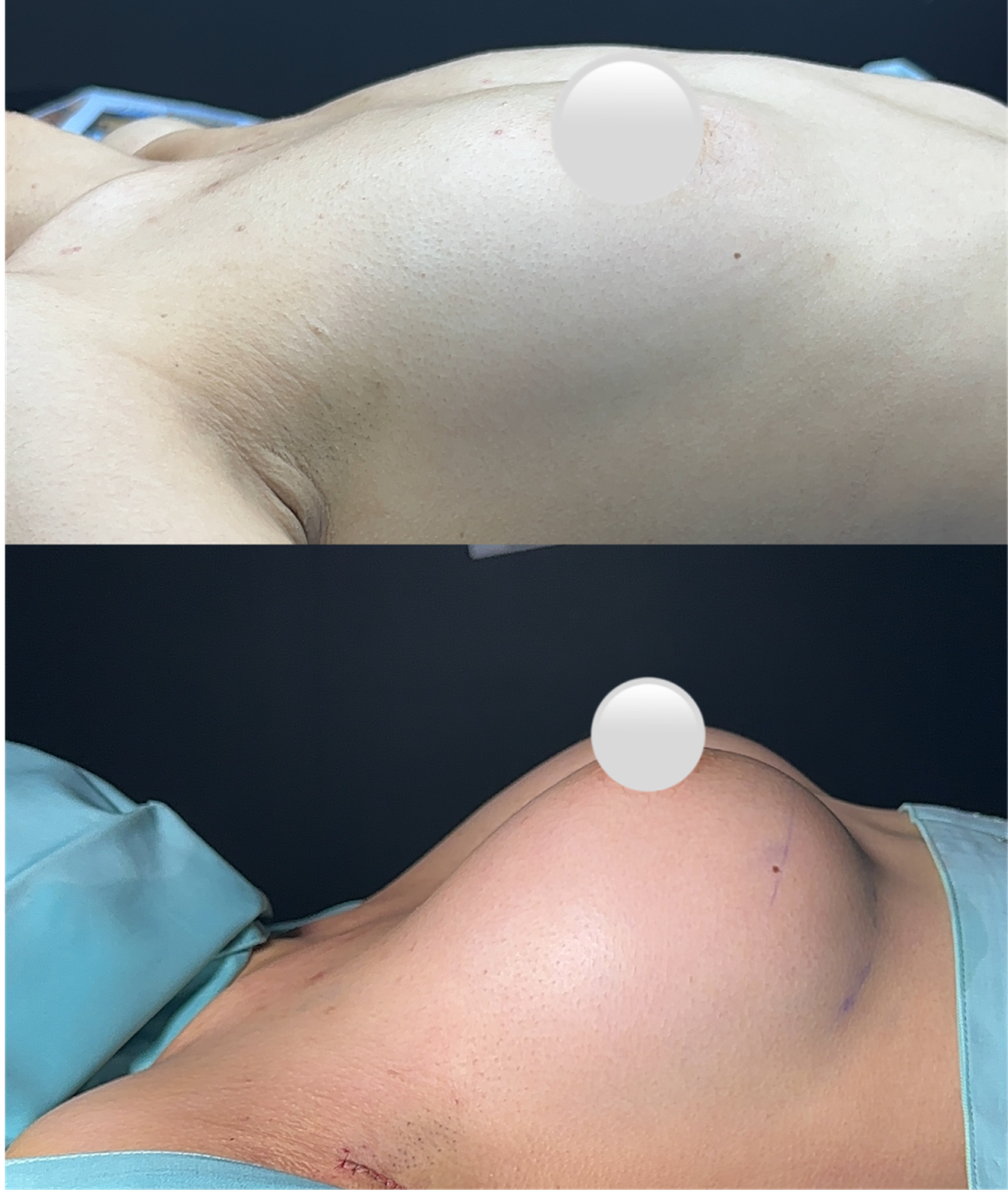 Chest implant augmentation case 2 before and after