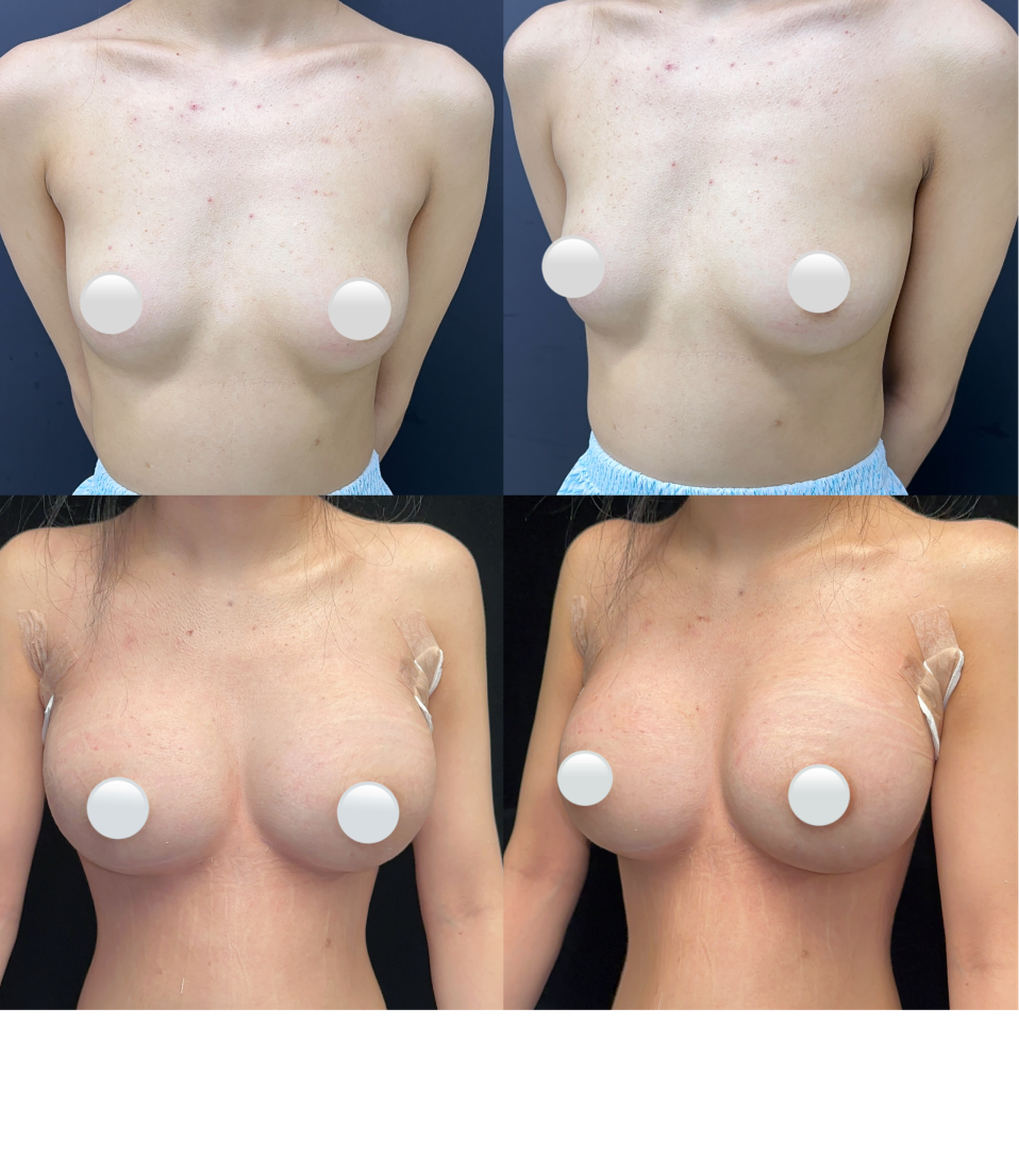 Chest implant augmentation case 2 additional before and after
