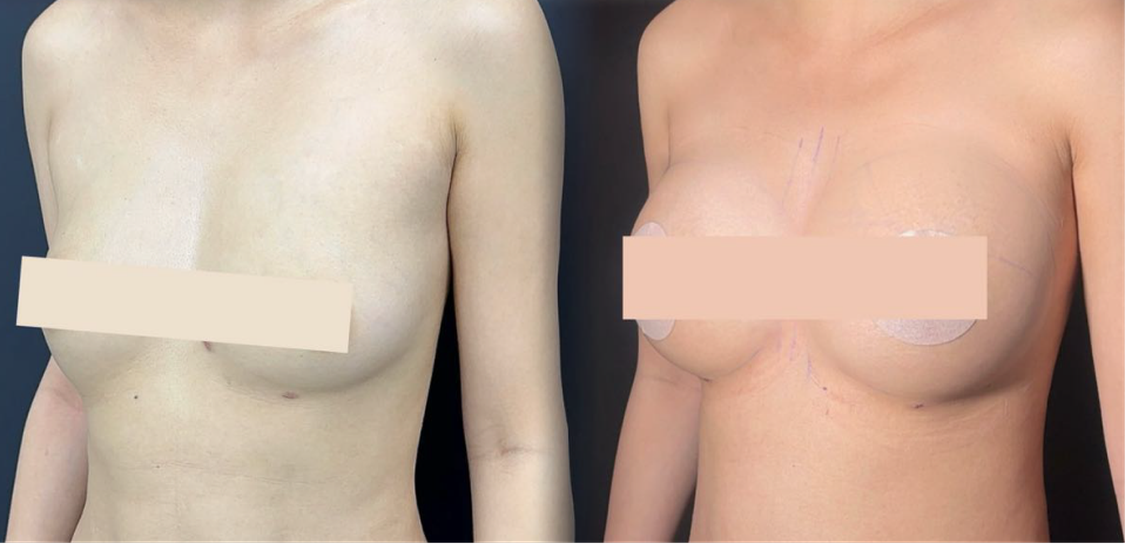 Fat graft chest augmentation case 1 before and after