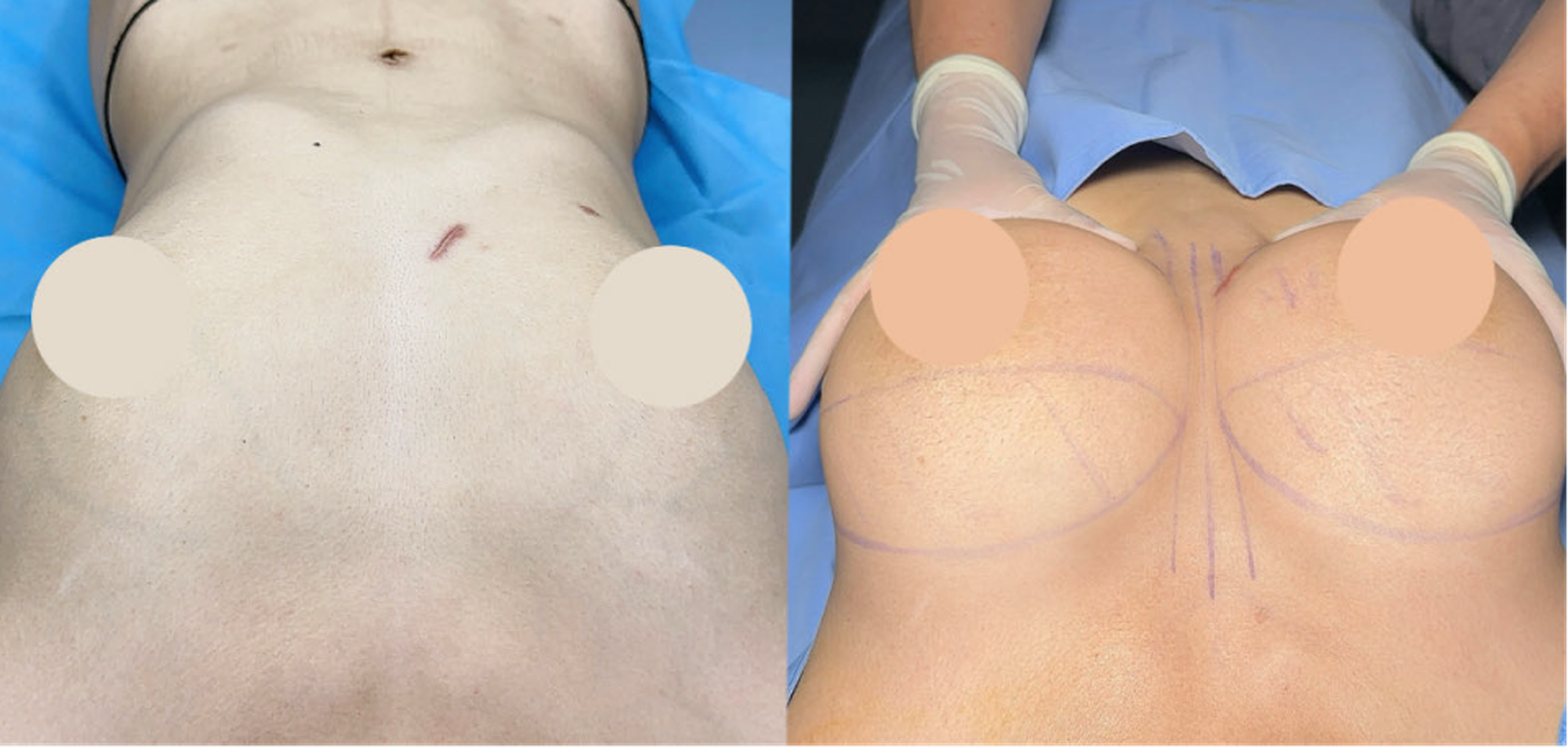 Fat graft chest augmentation case 1 additional before and after