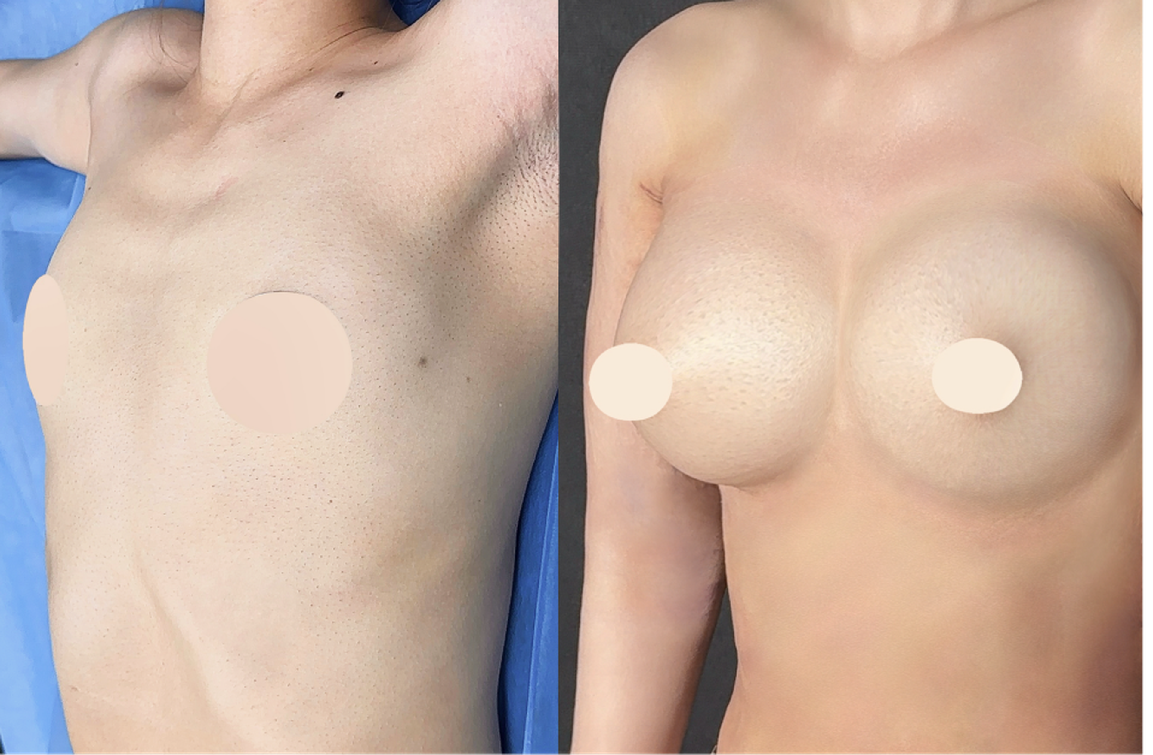 Fat graft chest augmentation case 2 before and after