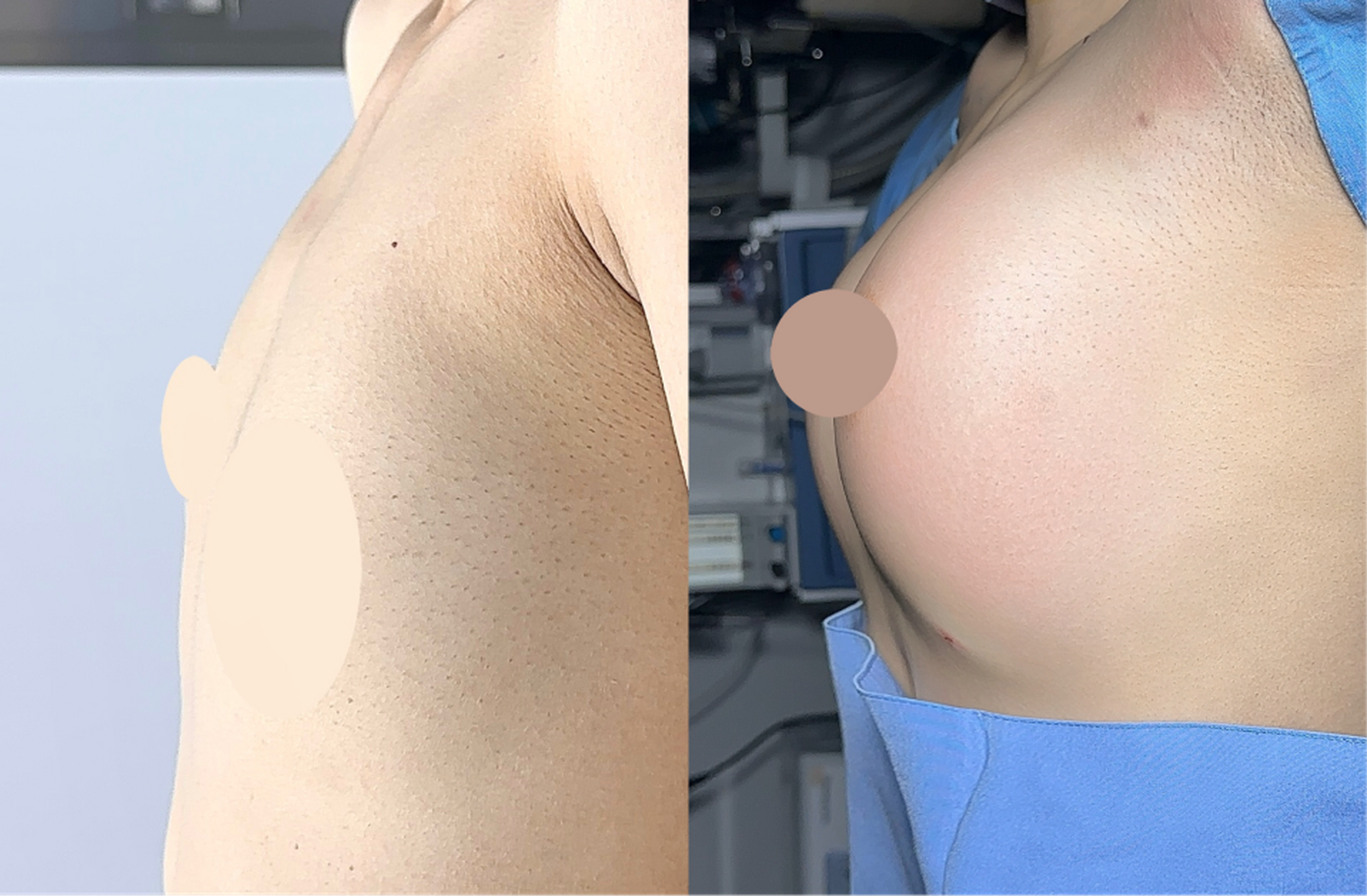 Fat graft chest augmentation case 2 additional before and after