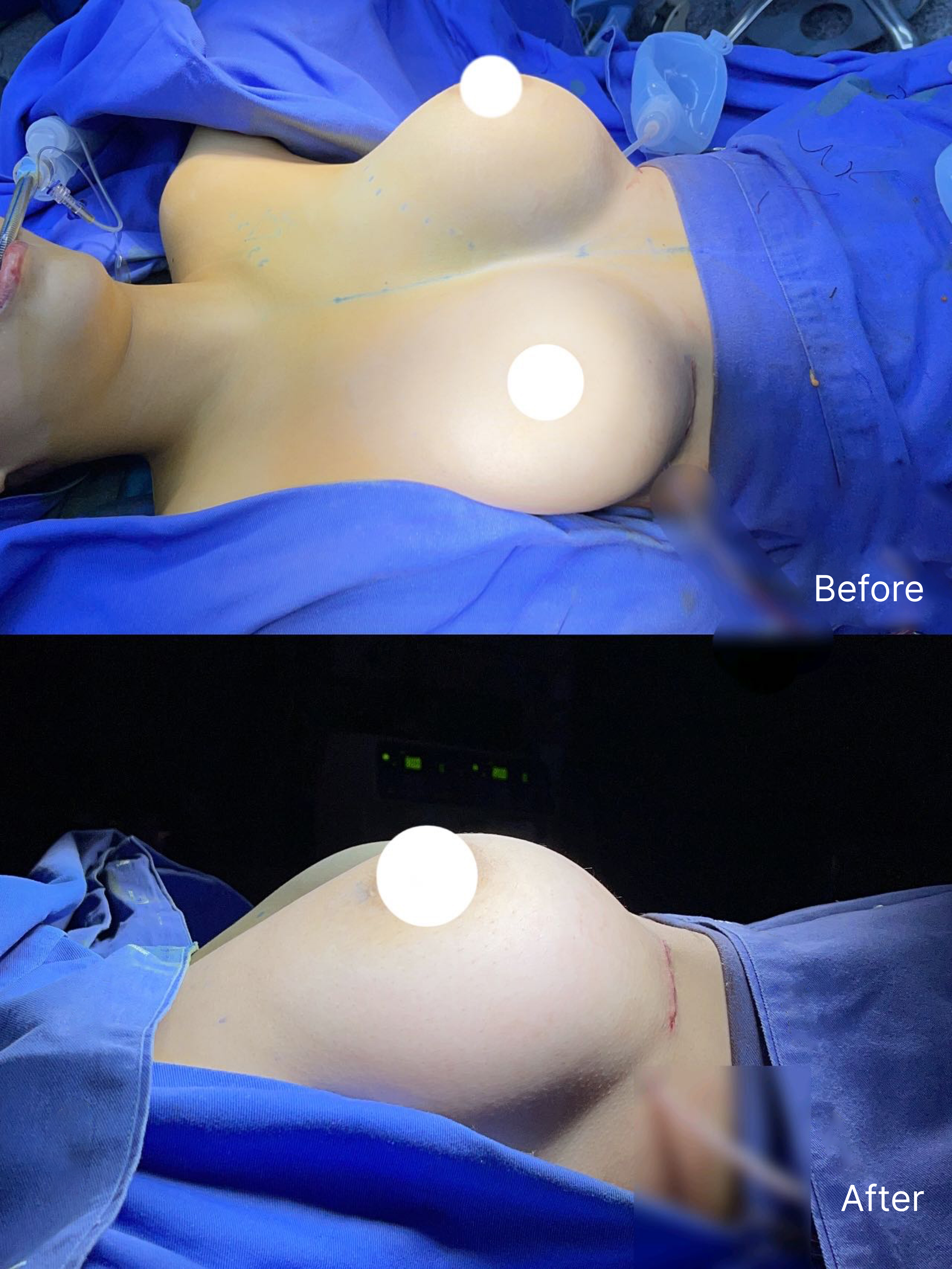 Breast reduction case 1 before and after surgical view