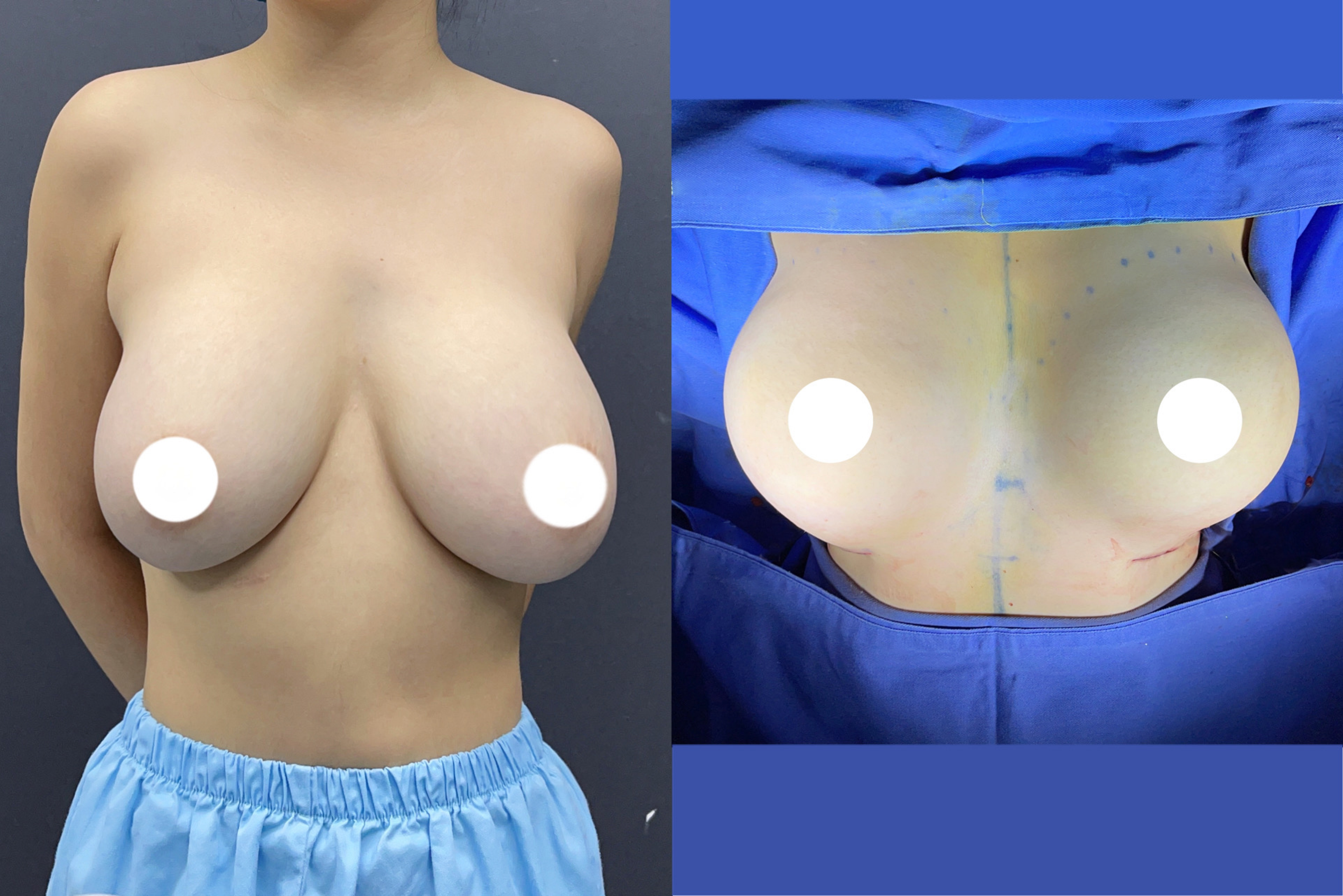 Breast reduction case 1 front before and after