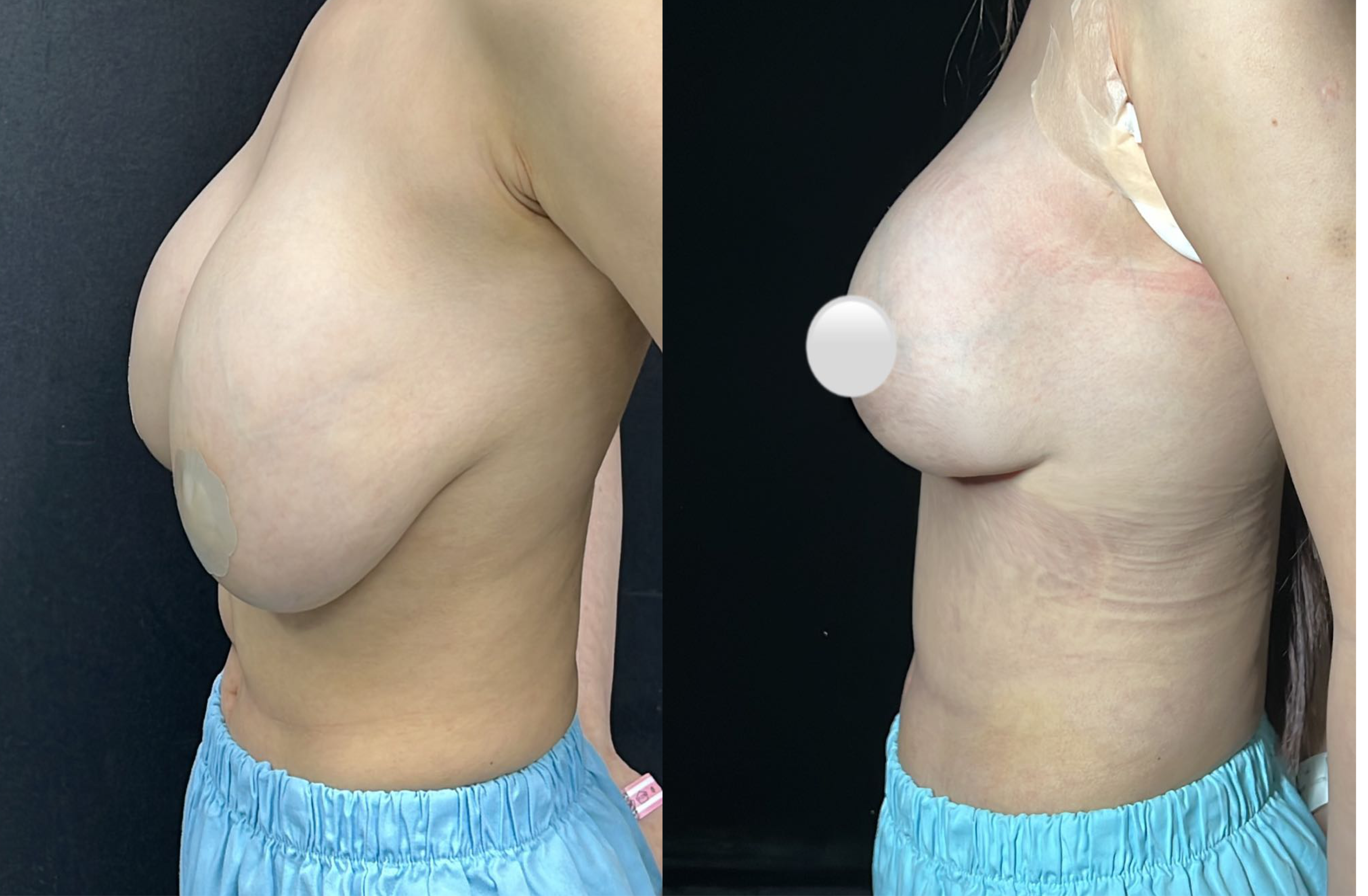 Breast reduction case 2 side before and after