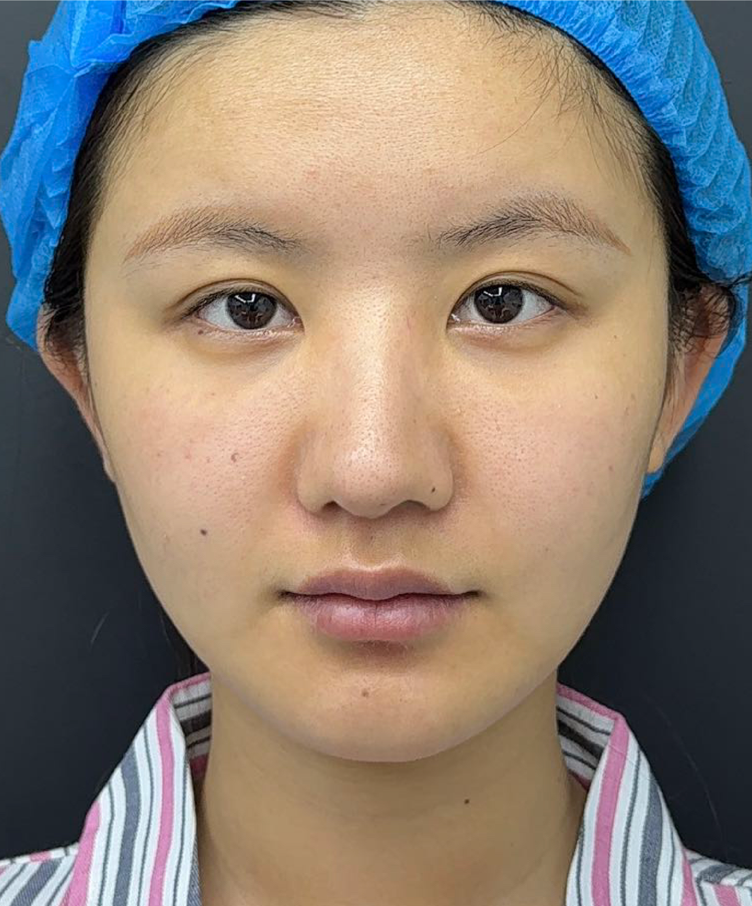Eye Surgery before
