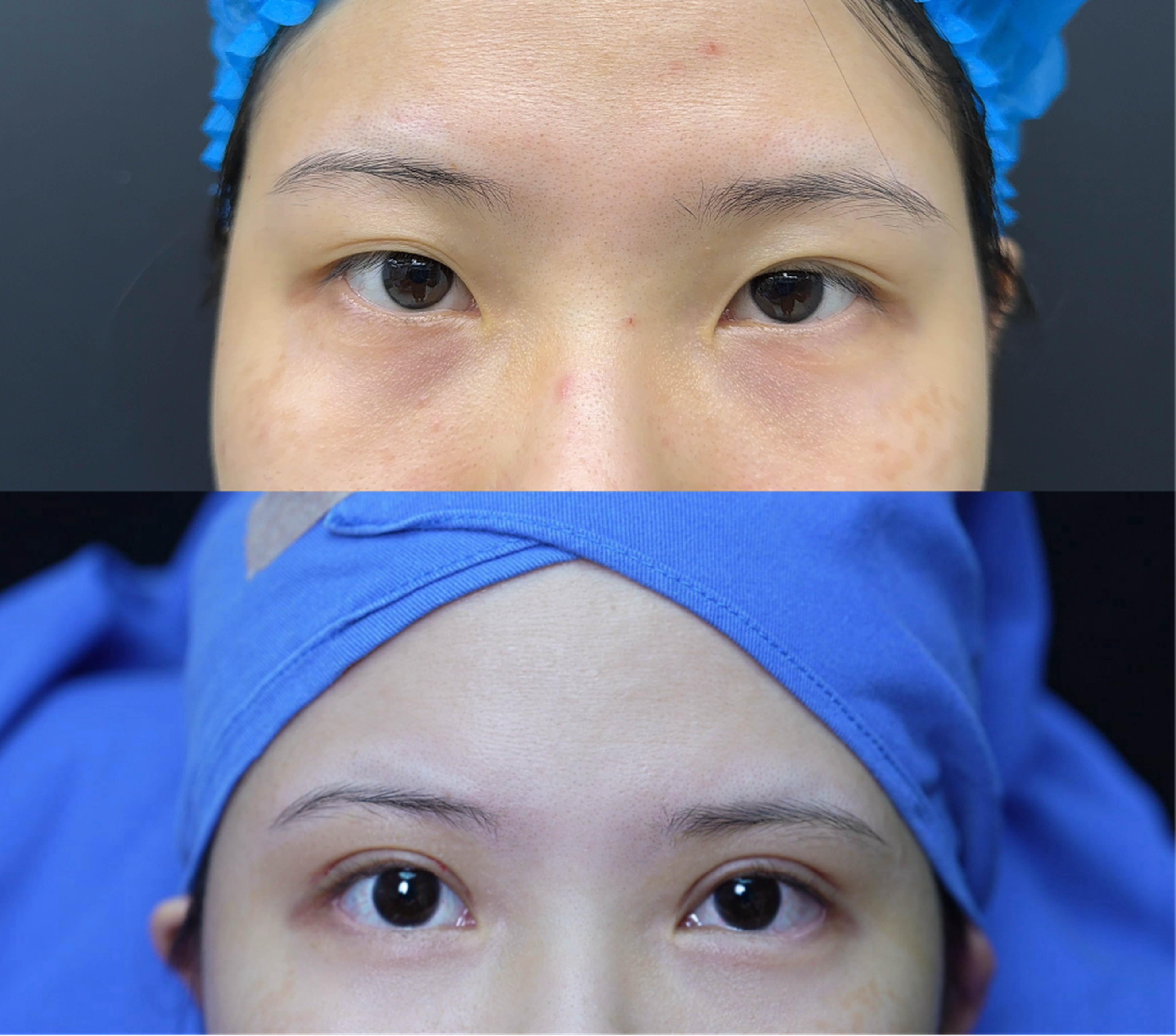 Comprehensive blepharoplasty case 1 before and after