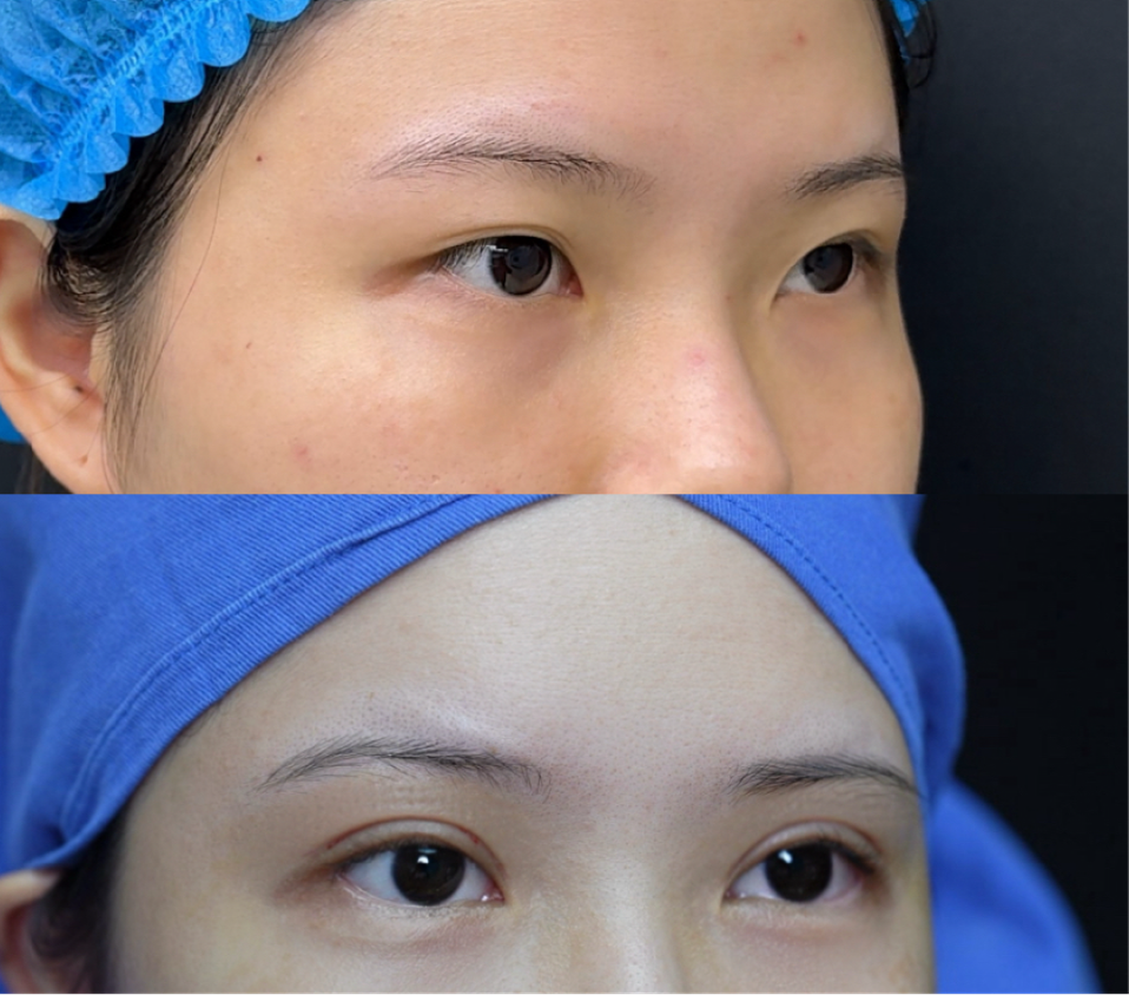 Comprehensive blepharoplasty case 1 additional before and after