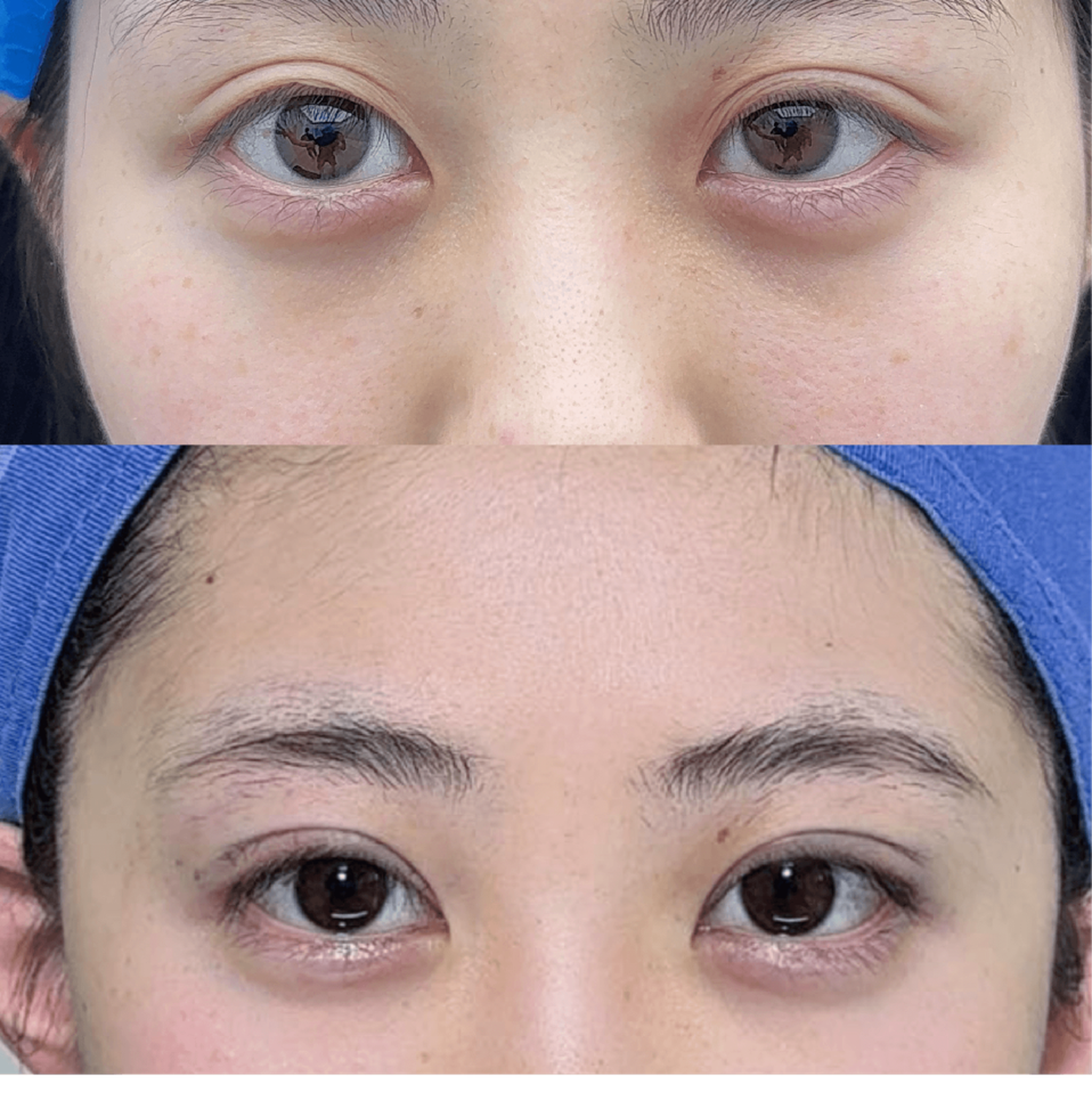 Comprehensive blepharoplasty case 2 before and after