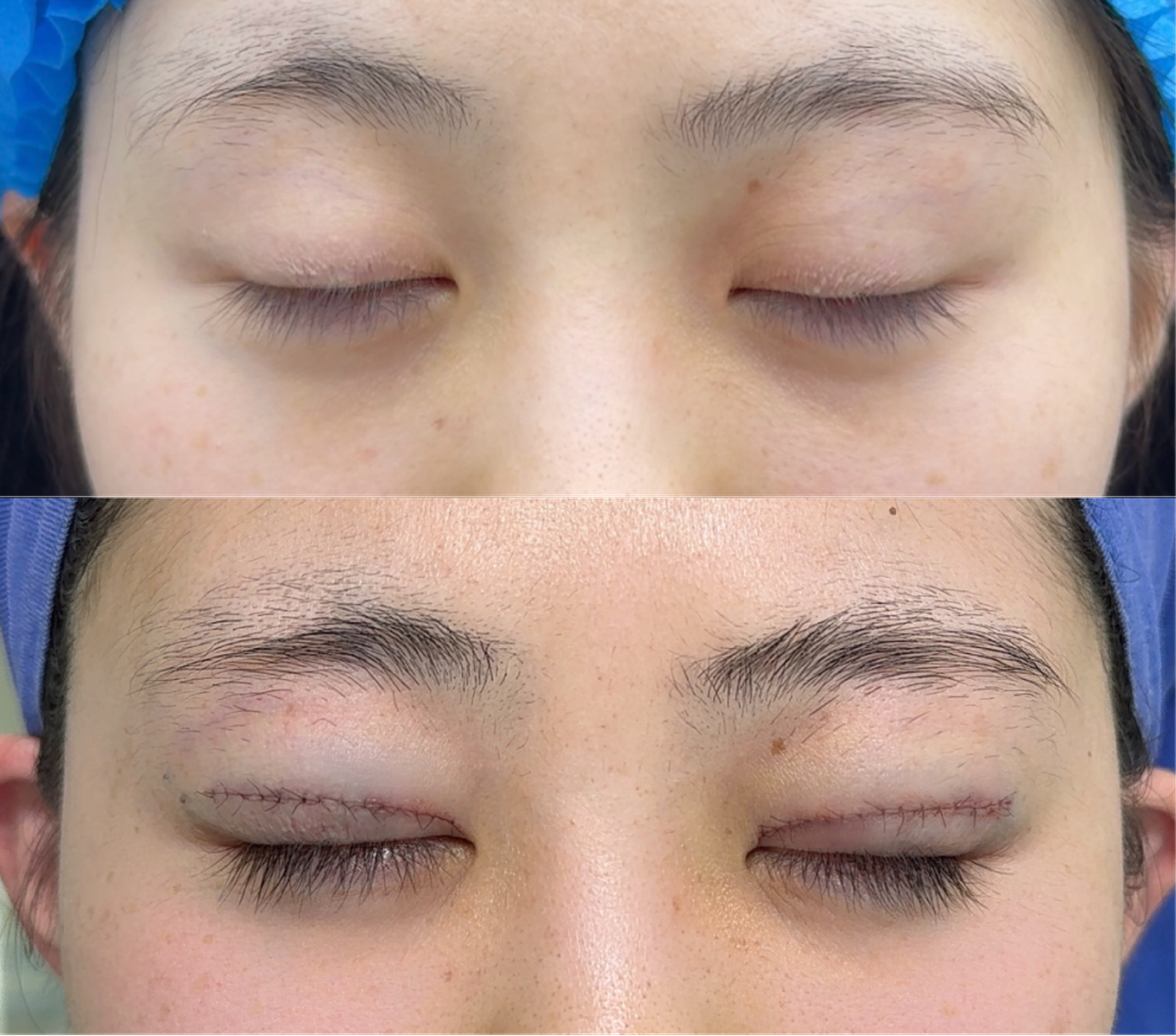 Comprehensive blepharoplasty case 2 additional before and after