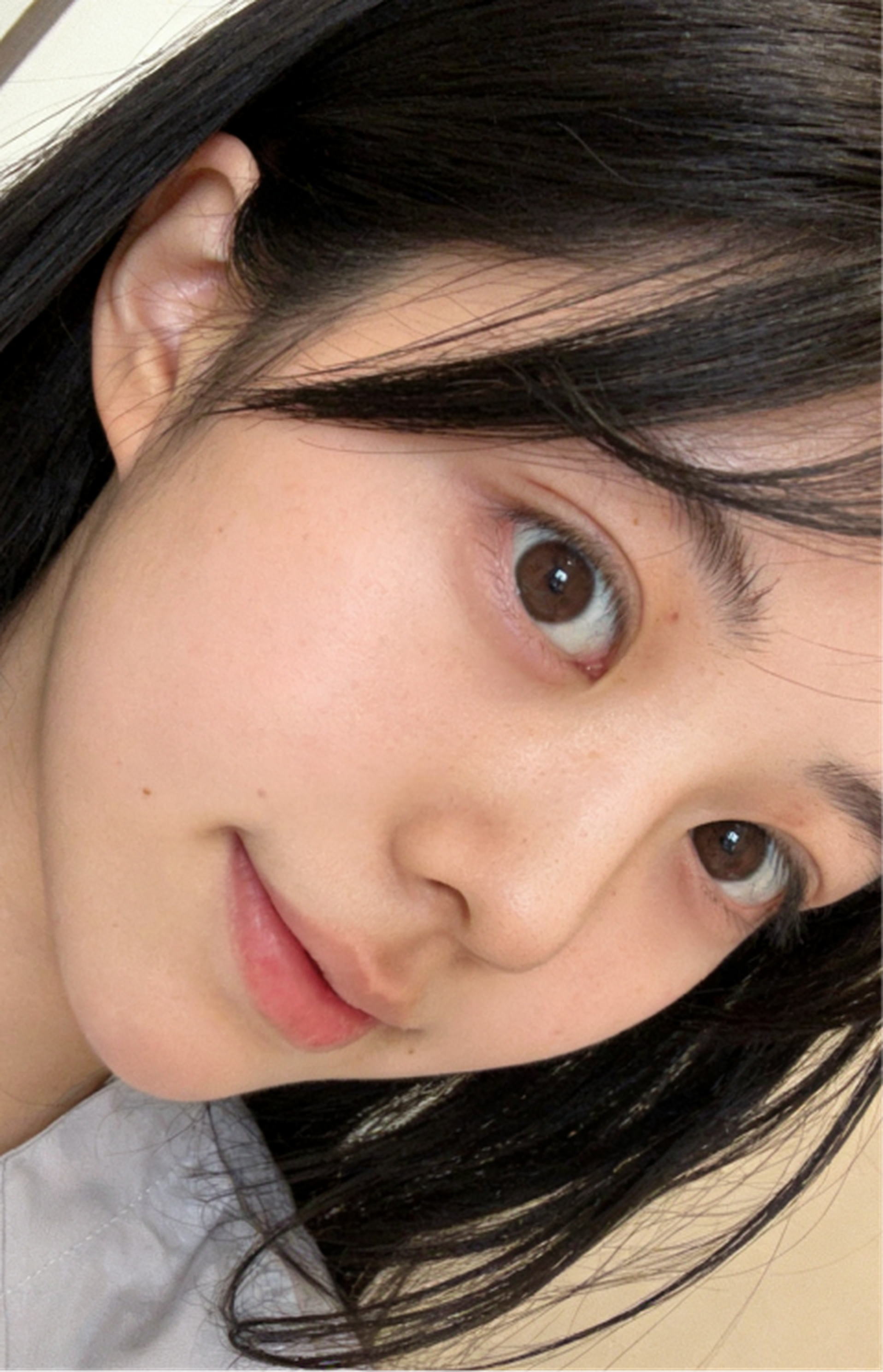 Comprehensive blepharoplasty case 2 feedback right