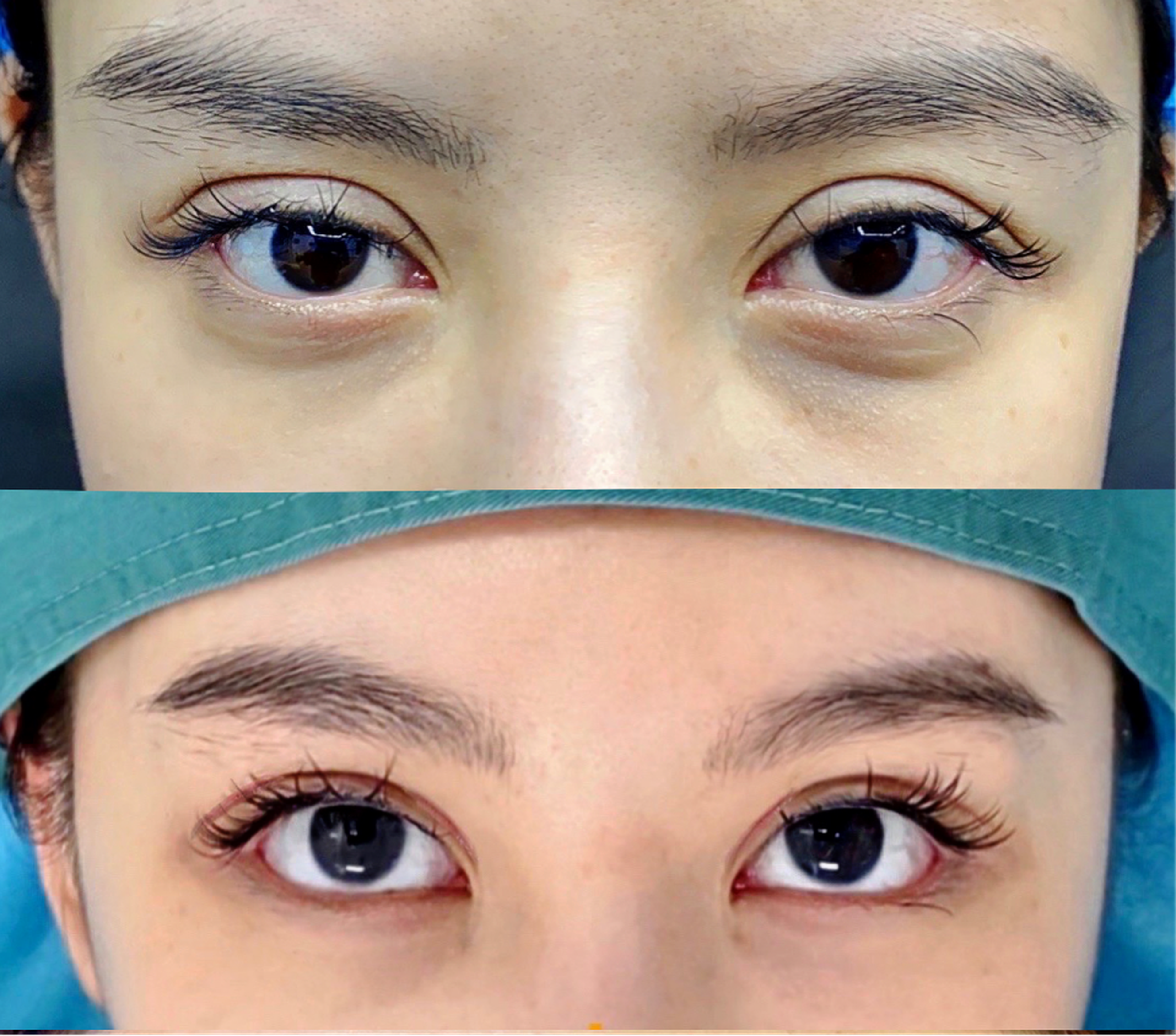 Revision blepharoplasty case 1 before and after