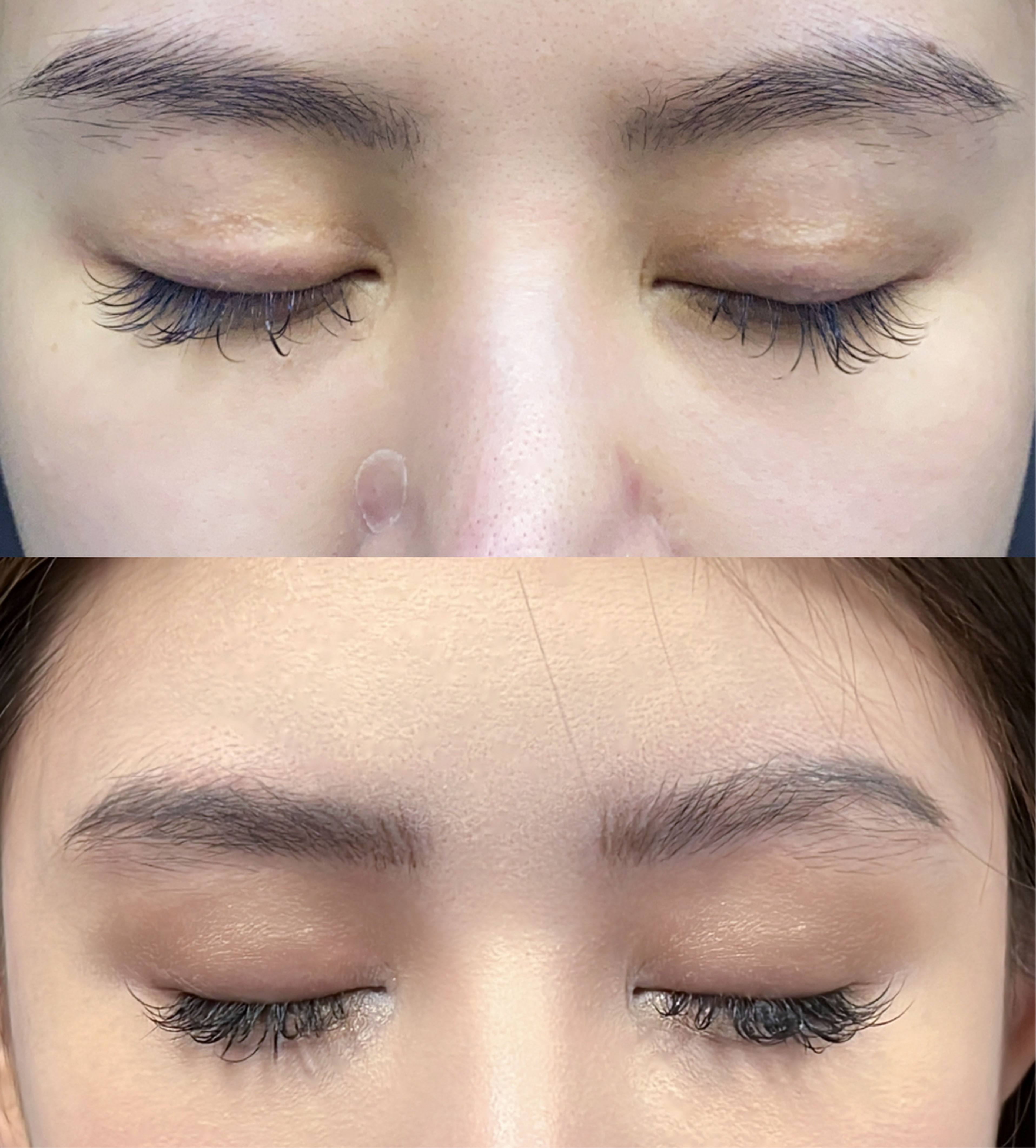 Revision blepharoplasty case 1 additional before and after