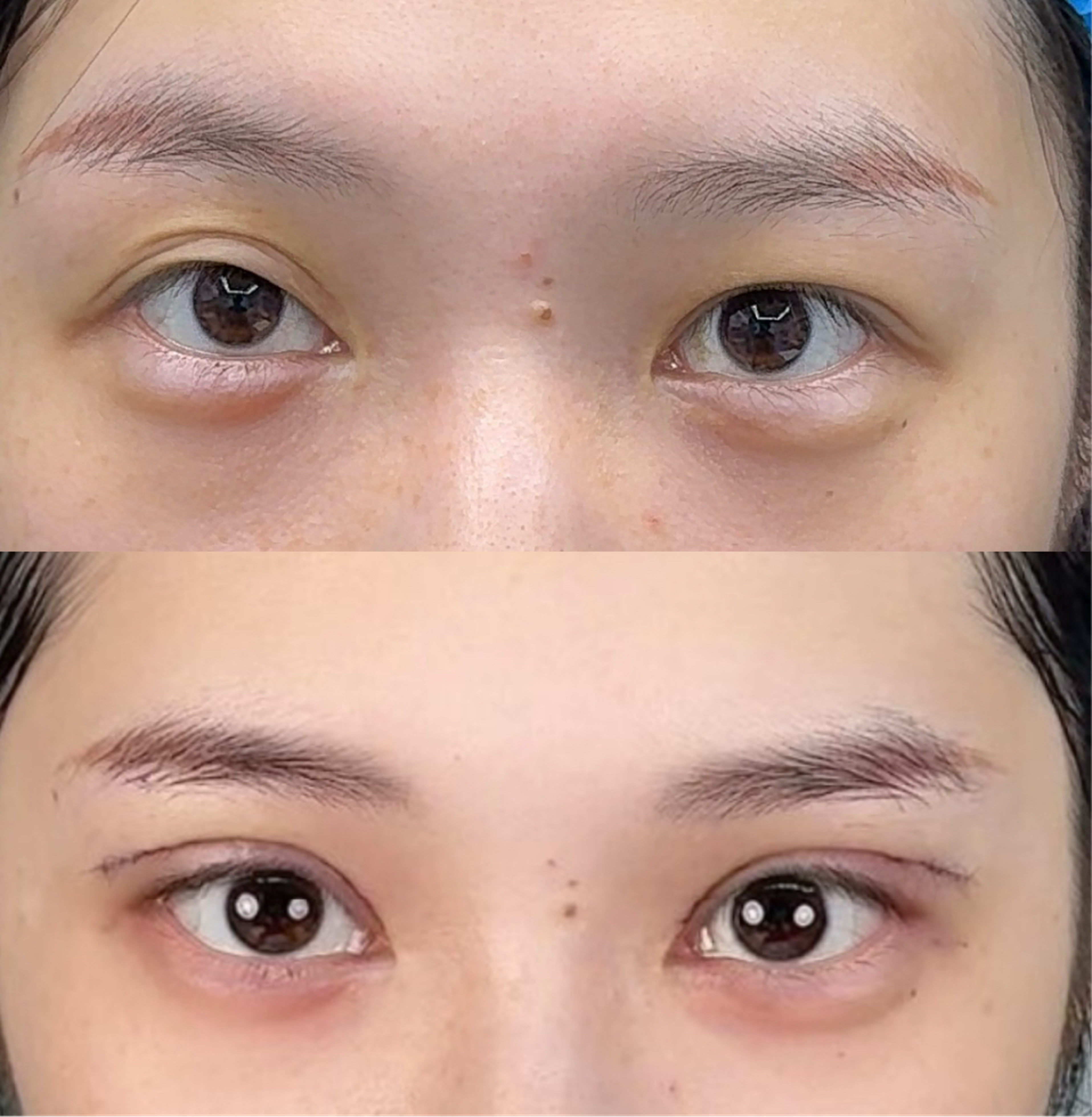 Revision blepharoplasty case 2 before and after