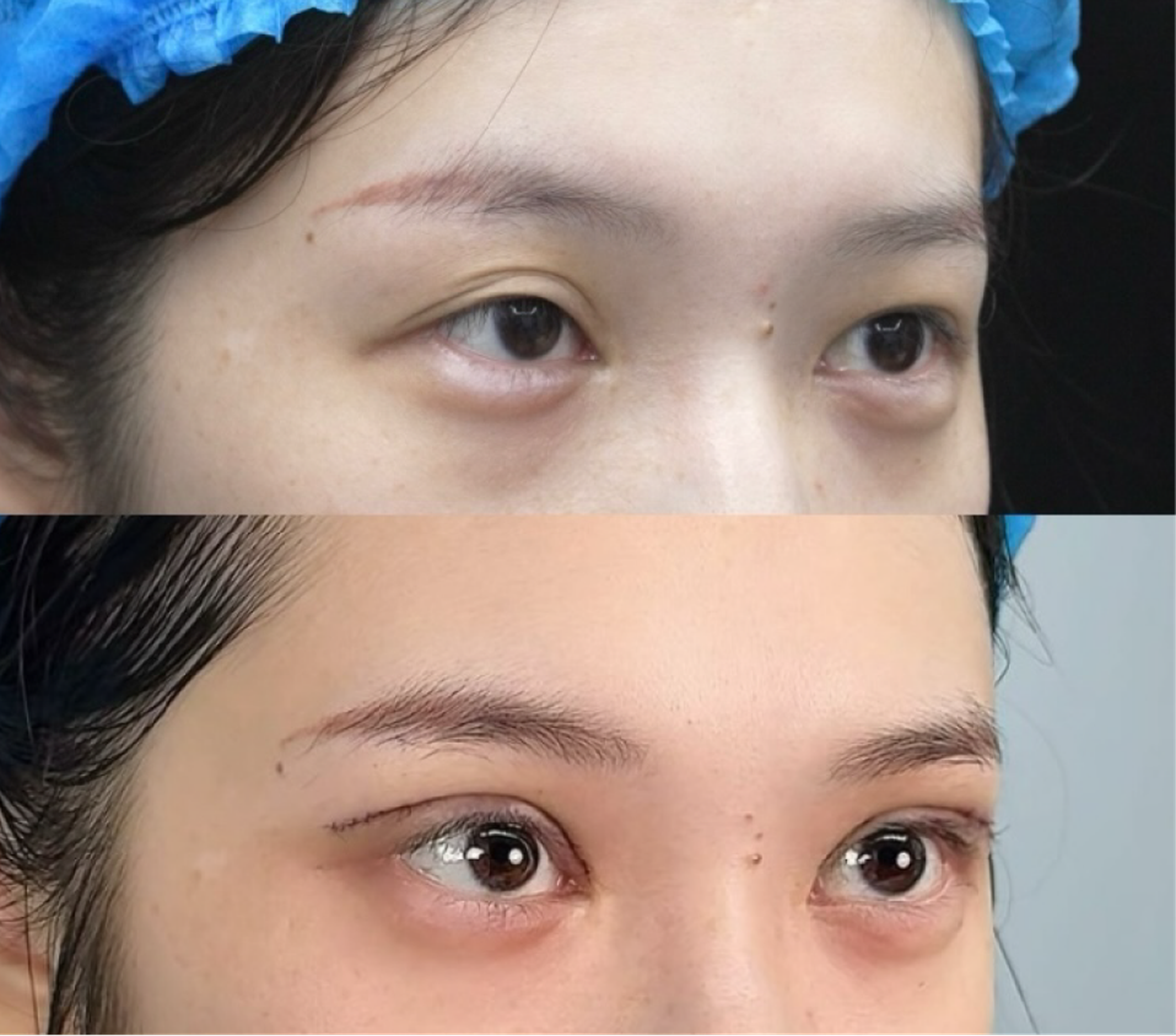 Revision blepharoplasty case 2 additional before and after