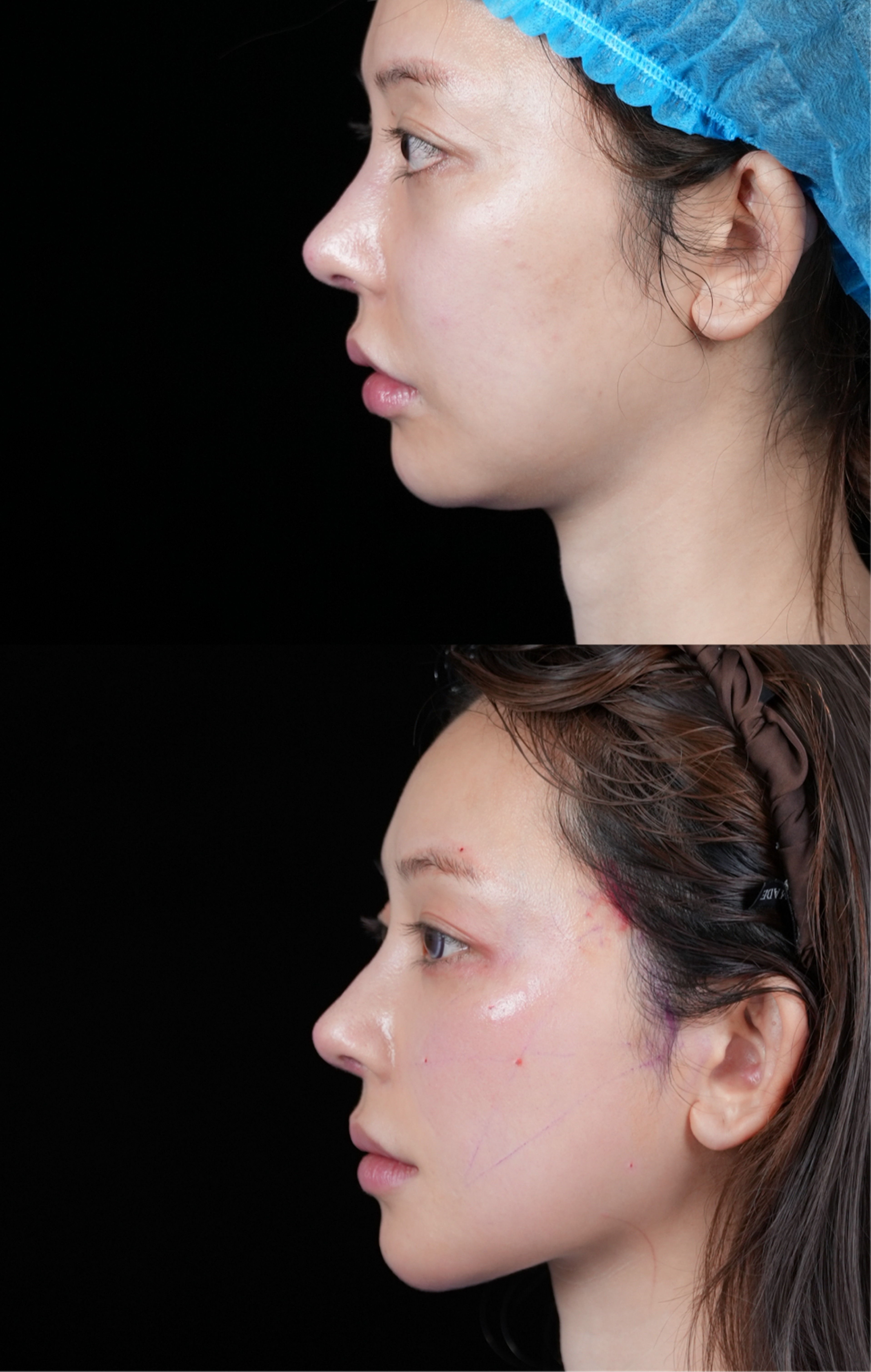Mid and lower face lift case 1 before and after