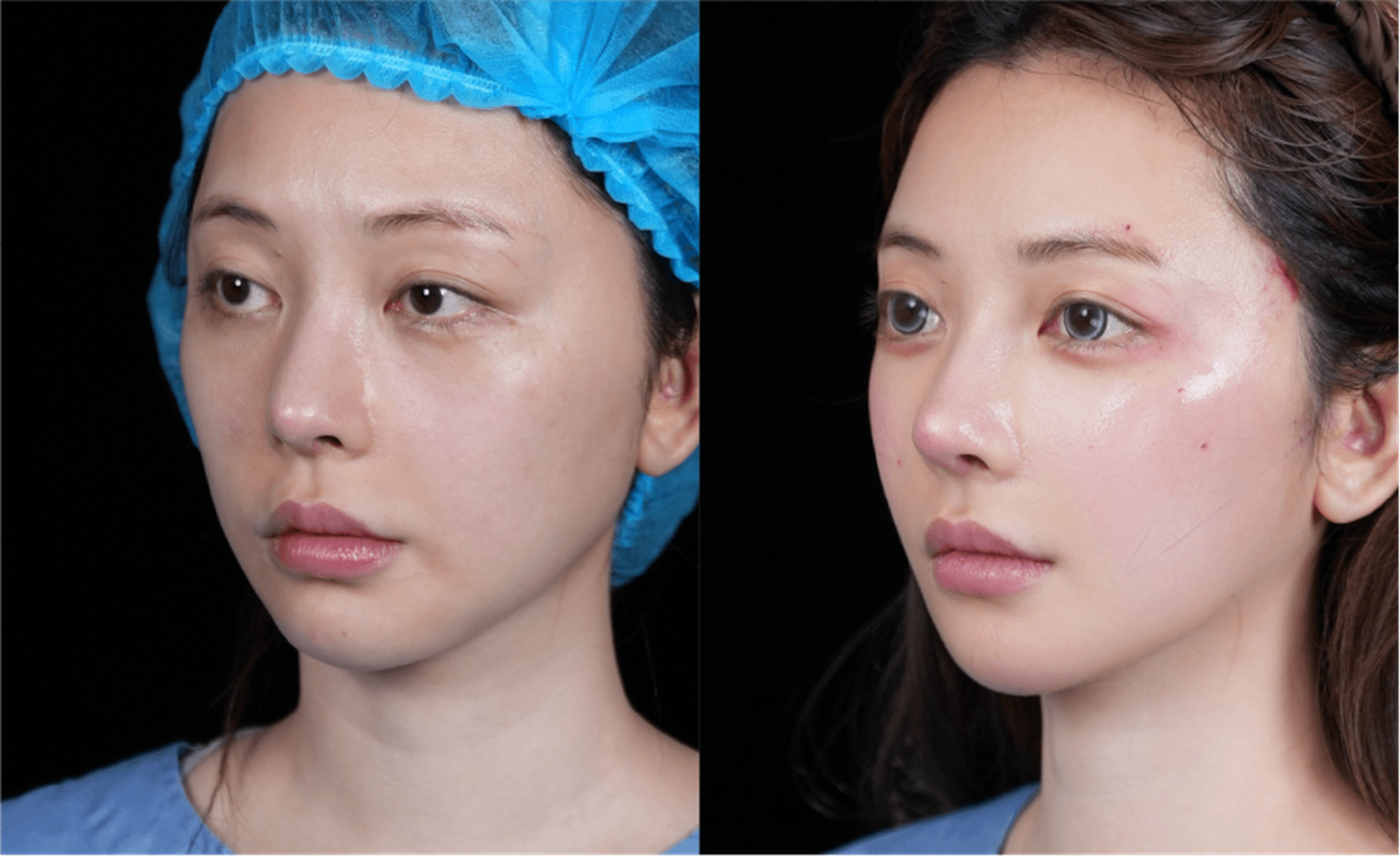 Mid and lower face lift case 1 additional before and after