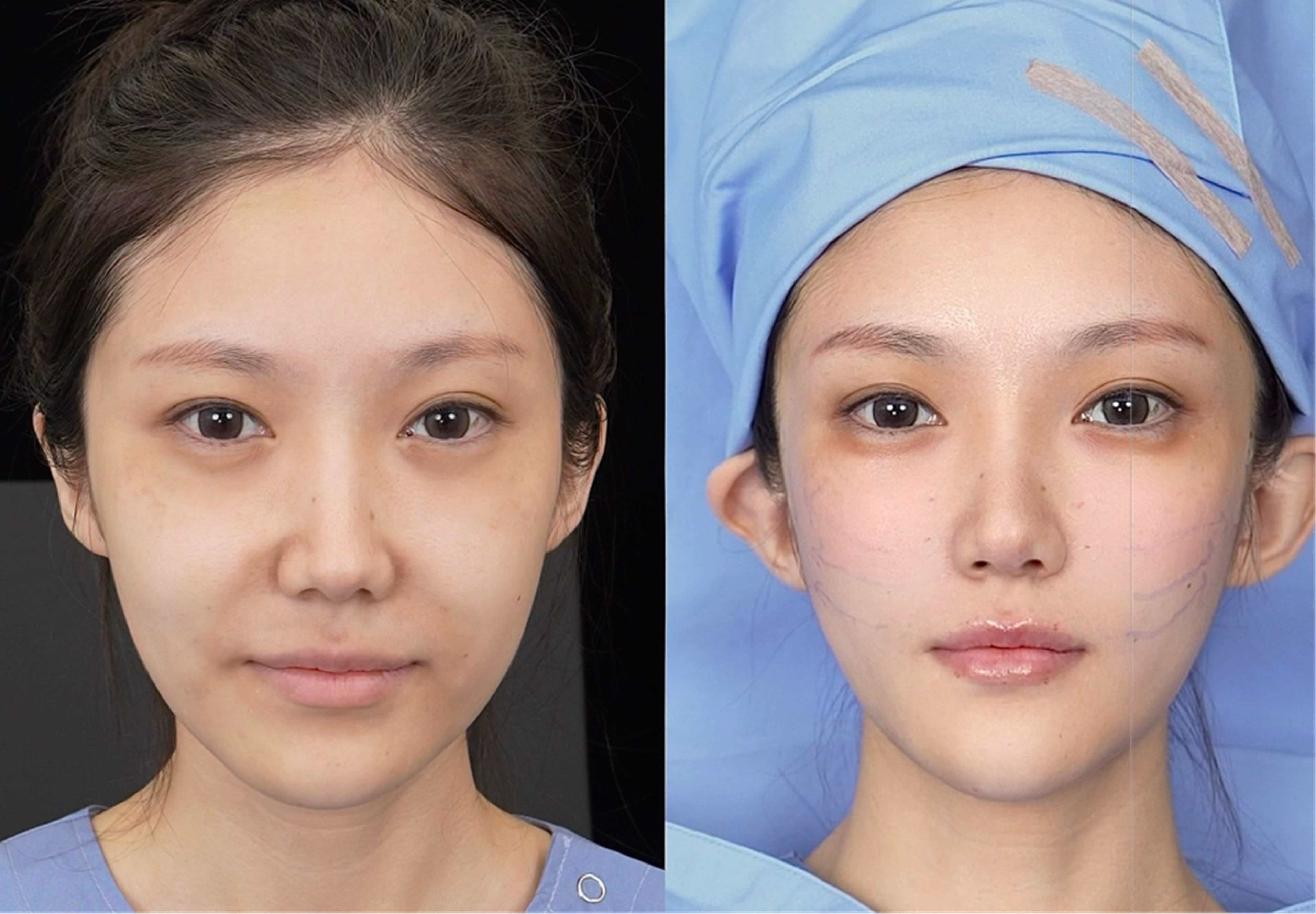 Mid and lower face lift case 2 before and after