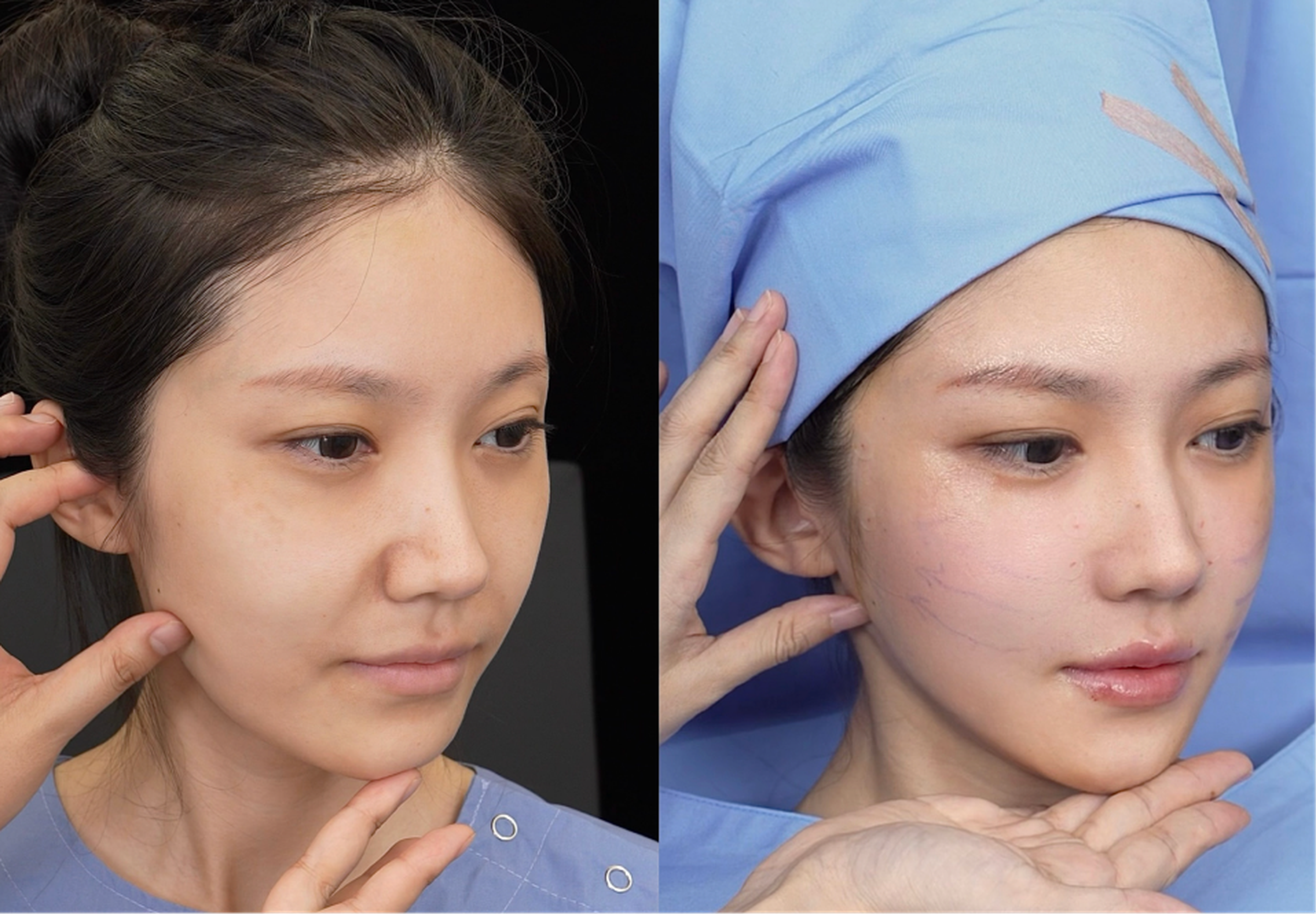 Mid and lower face lift case 2 additional before and after