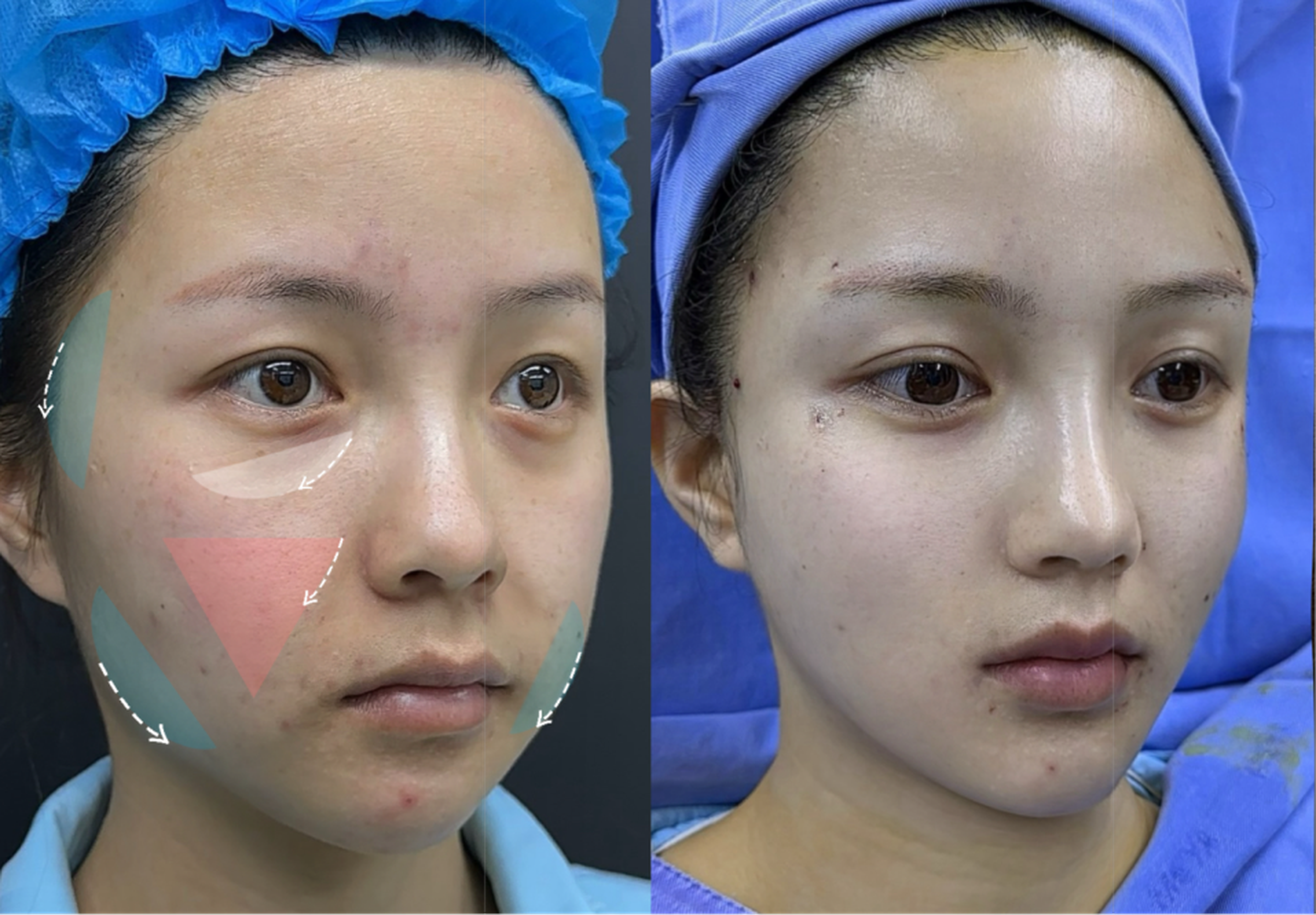 Malar fat pad repositioning case 1 before and after