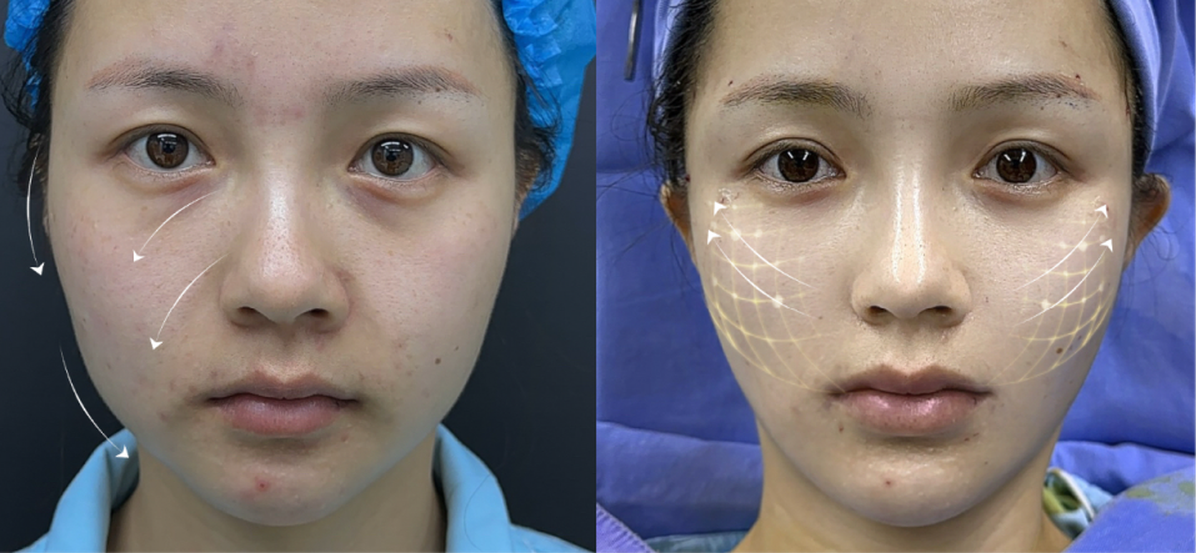 Malar fat pad repositioning case 1 additional before and after