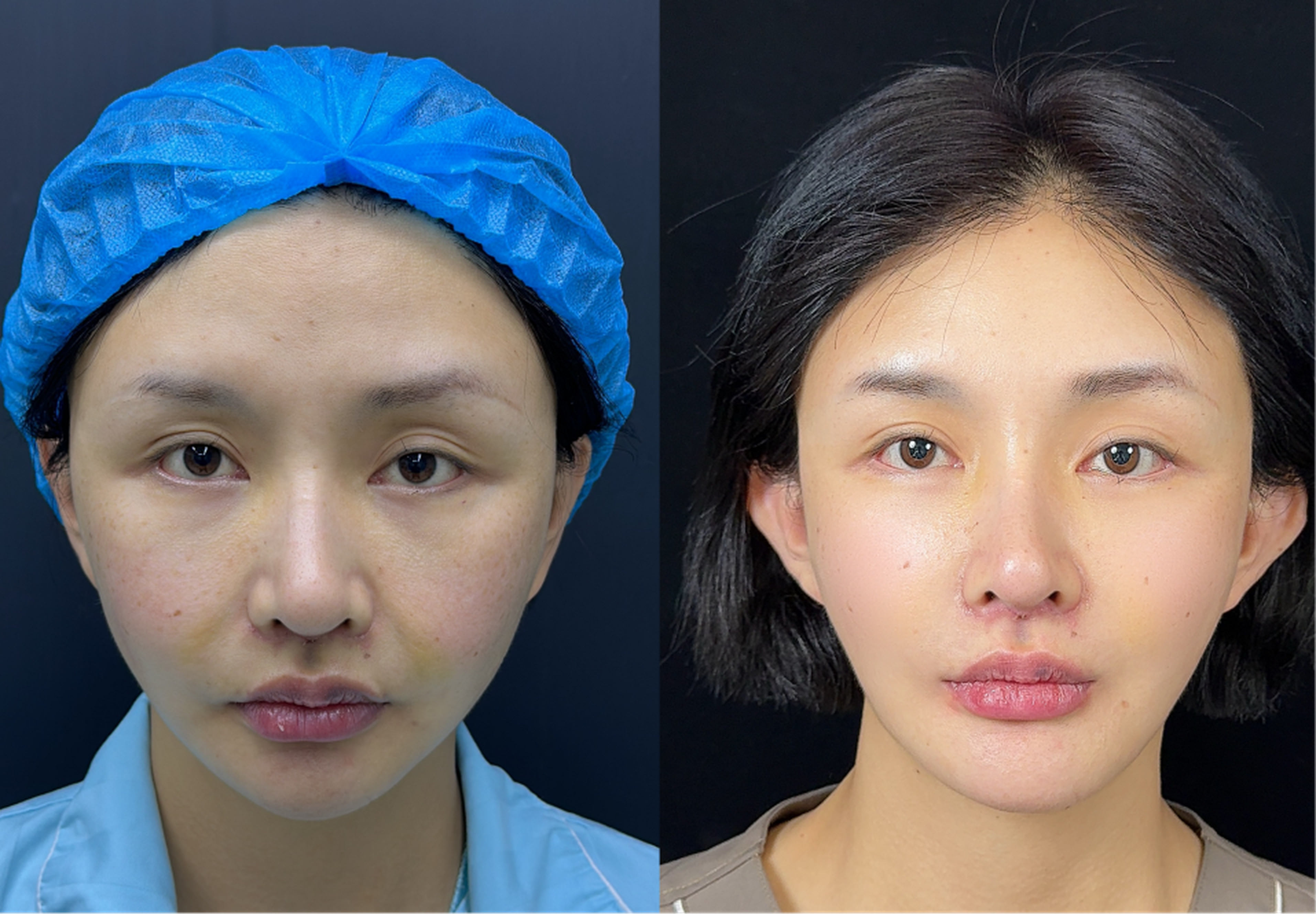 Malar fat pad repositioning case 2 before and after