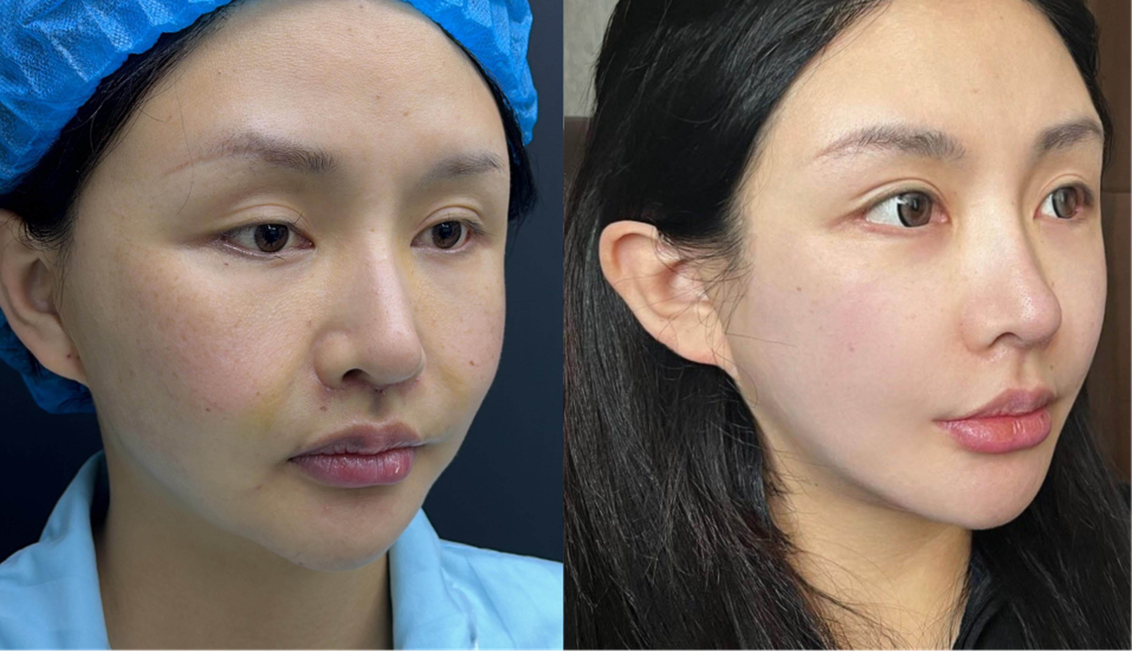 Malar fat pad repositioning case 2 additional before and after