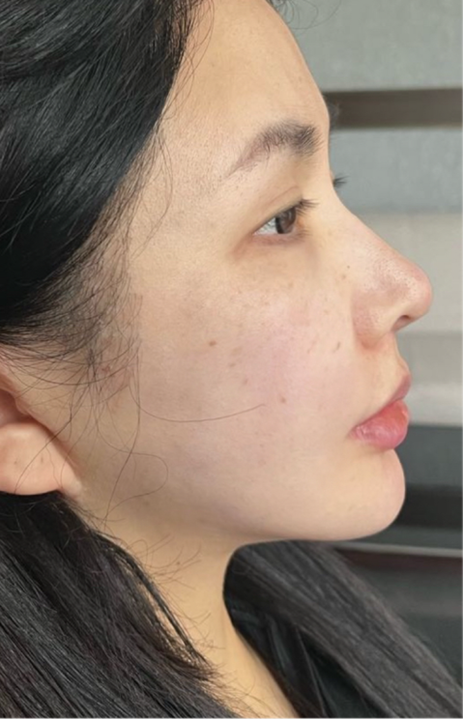 Malar fat pad repositioning case 2 feedback left
