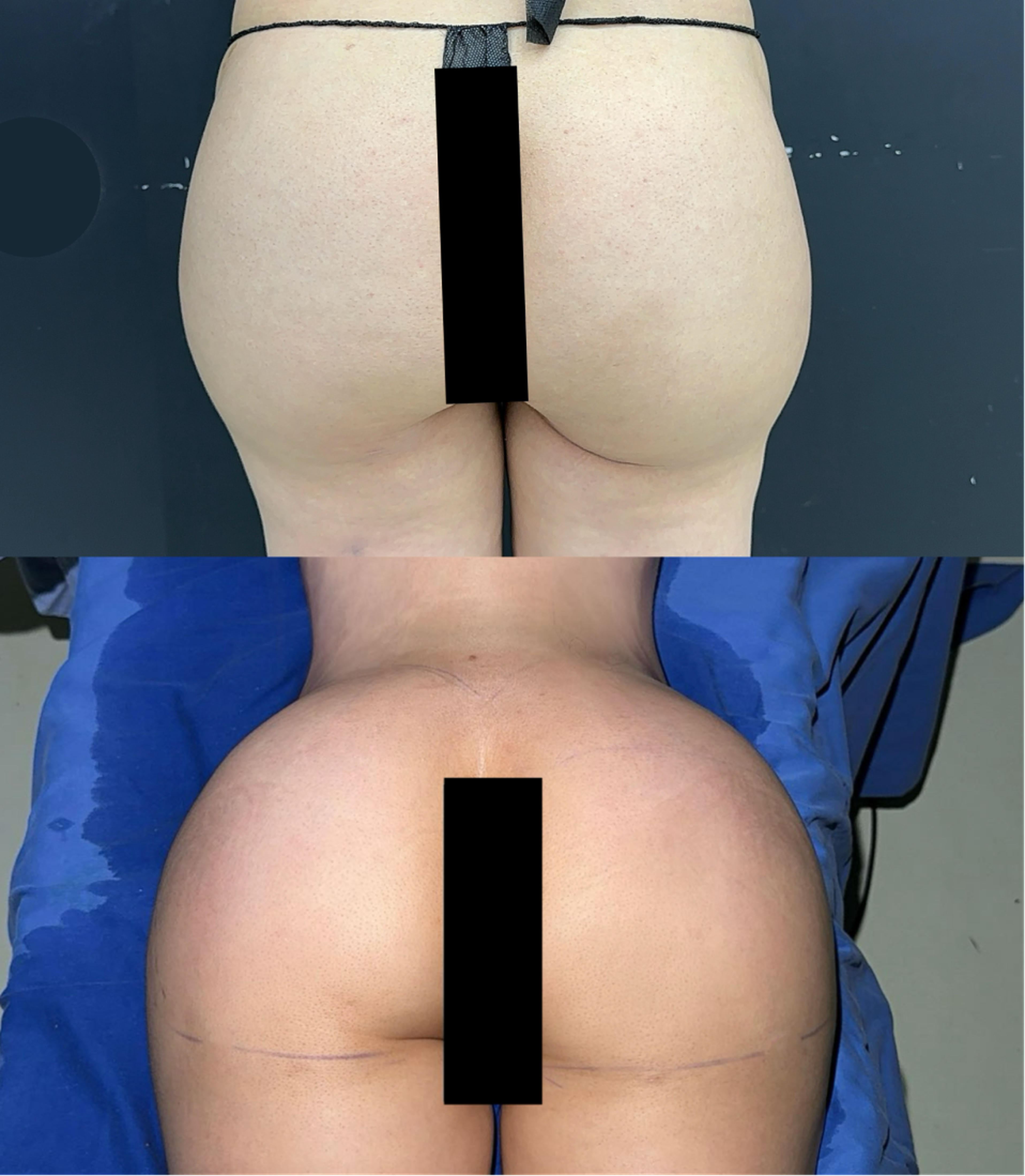 Autologous fat grafting case 1 before and after middle view