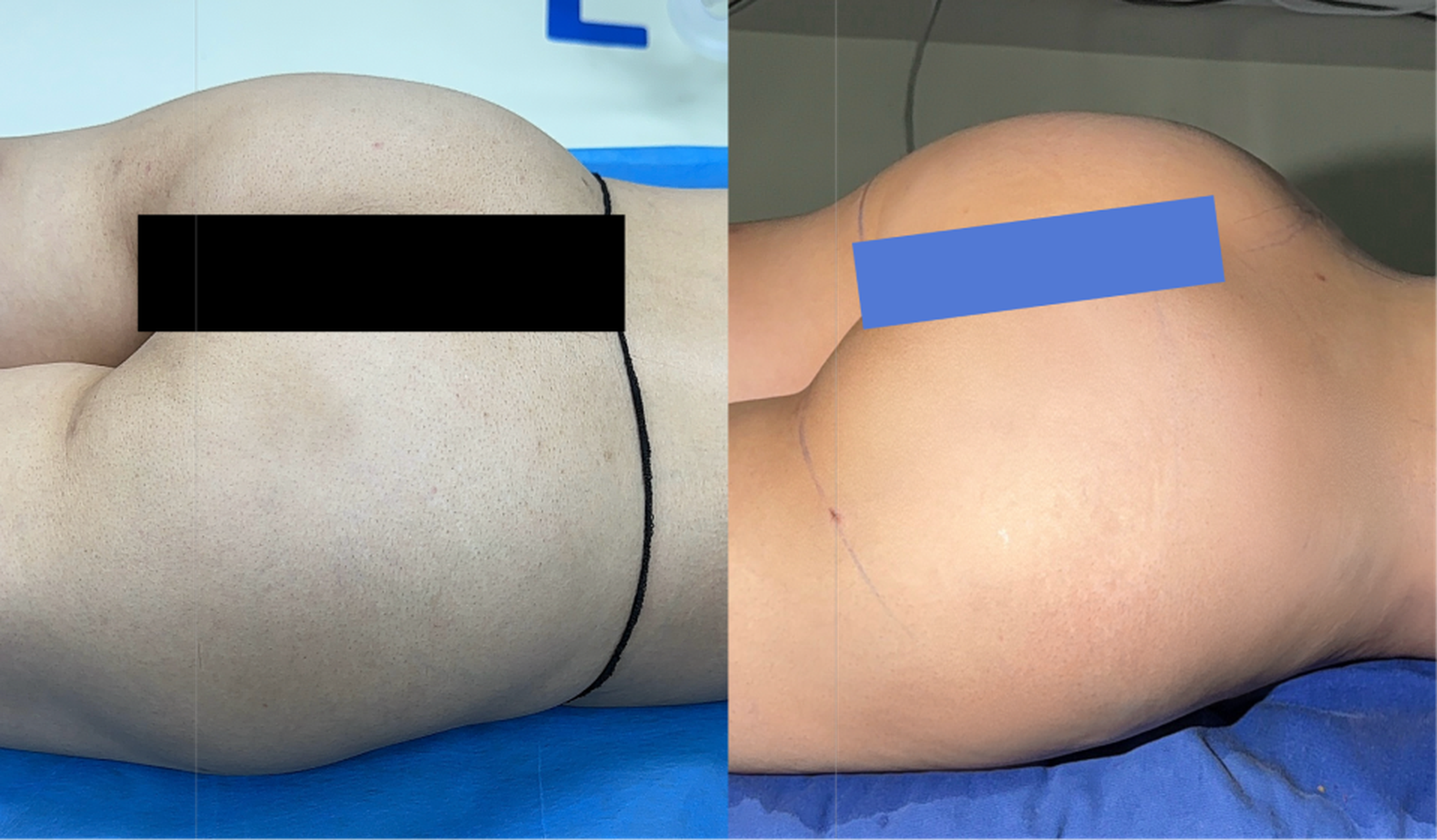 Autologous fat grafting case 1 before and after top view