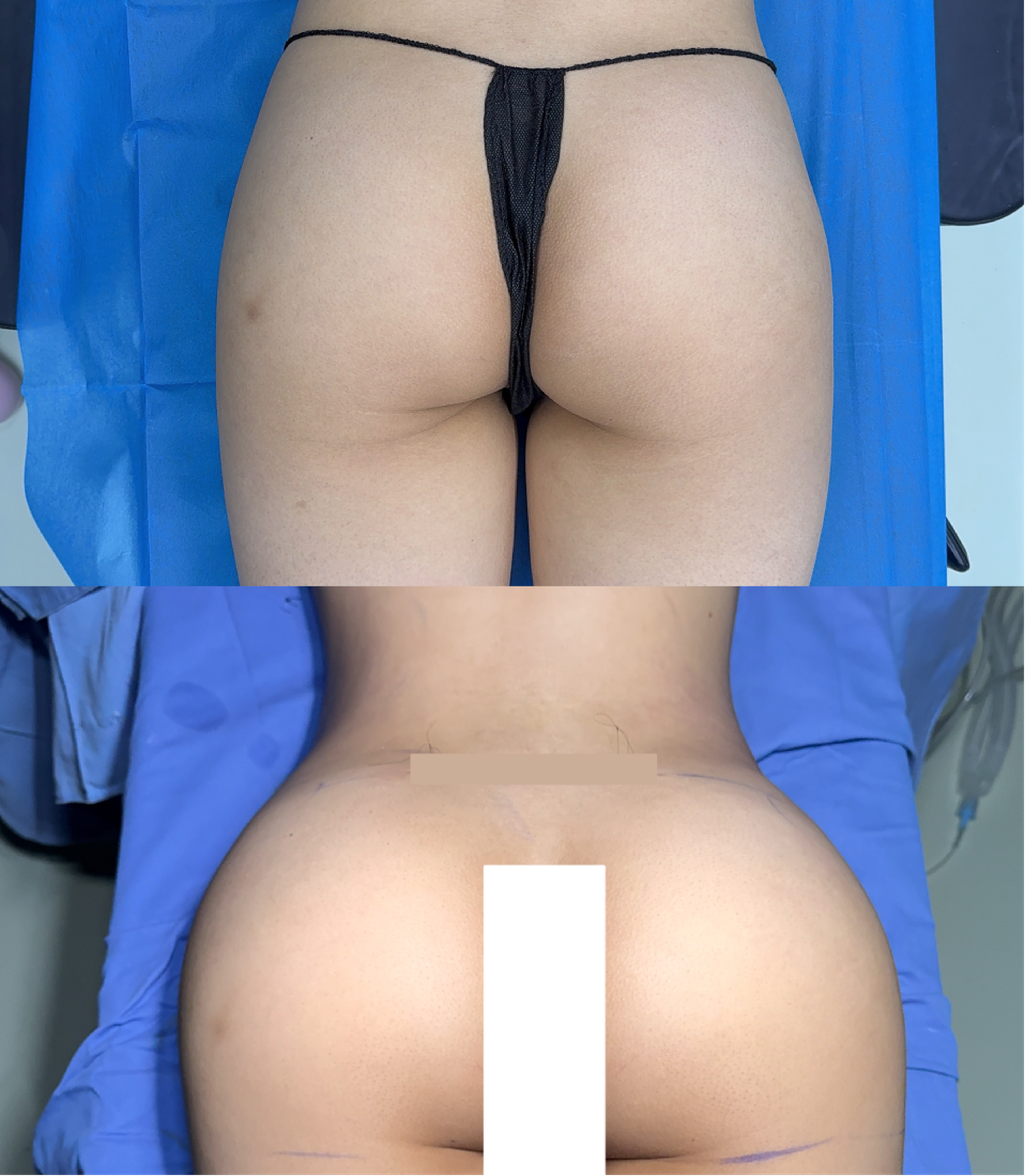 Autologous fat grafting case 2 before and after middle view