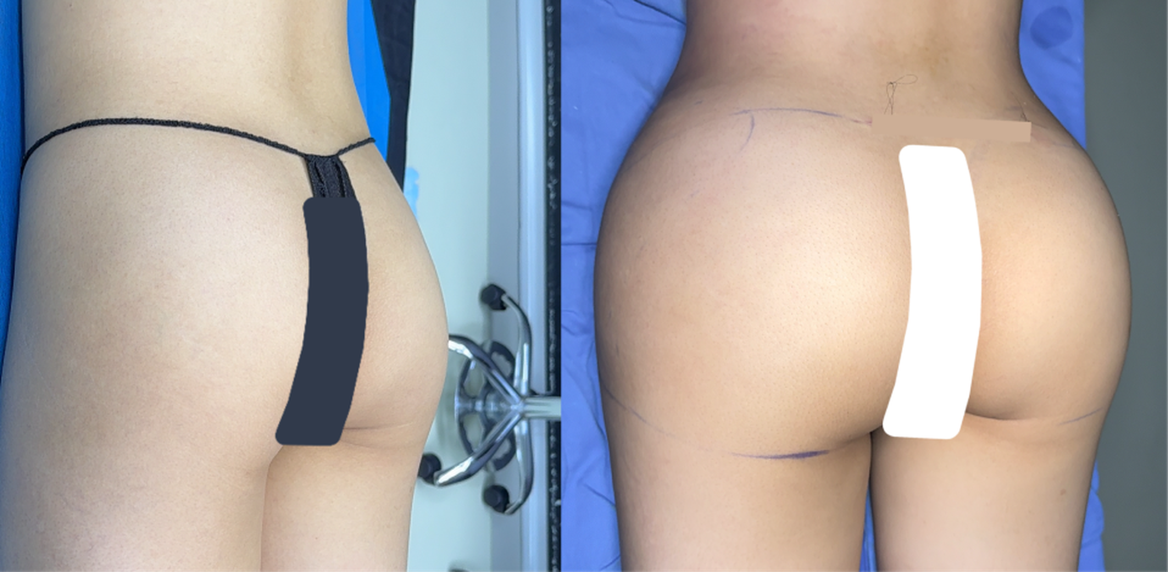 Autologous fat grafting case 2 before and after top view