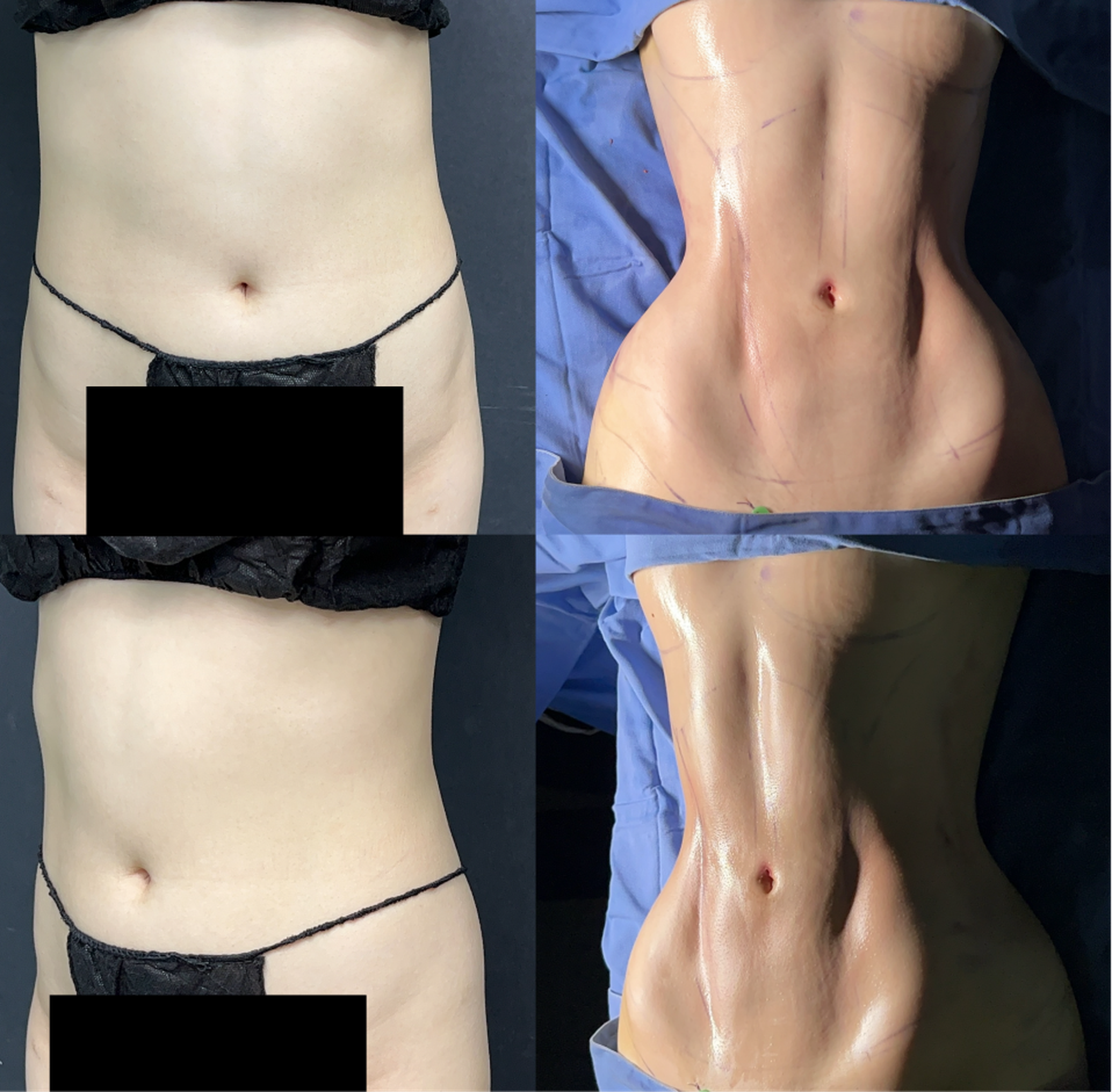 Waist and abdominal liposuction case 1 before and after middle view
