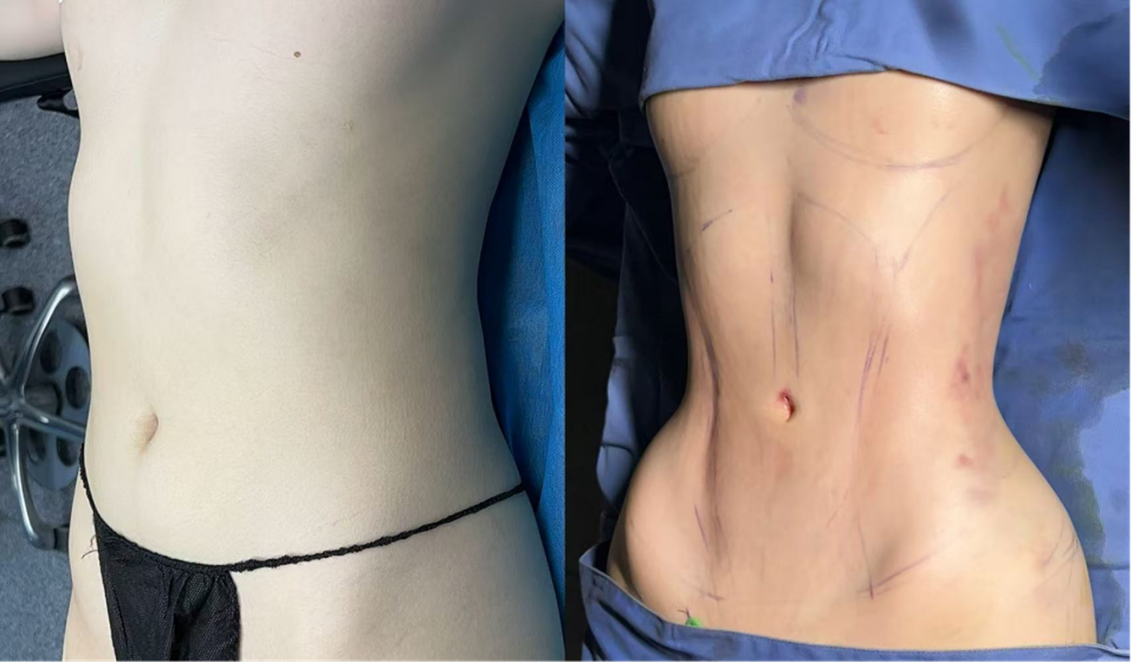 Waist and abdominal liposuction case 1 before and after top view