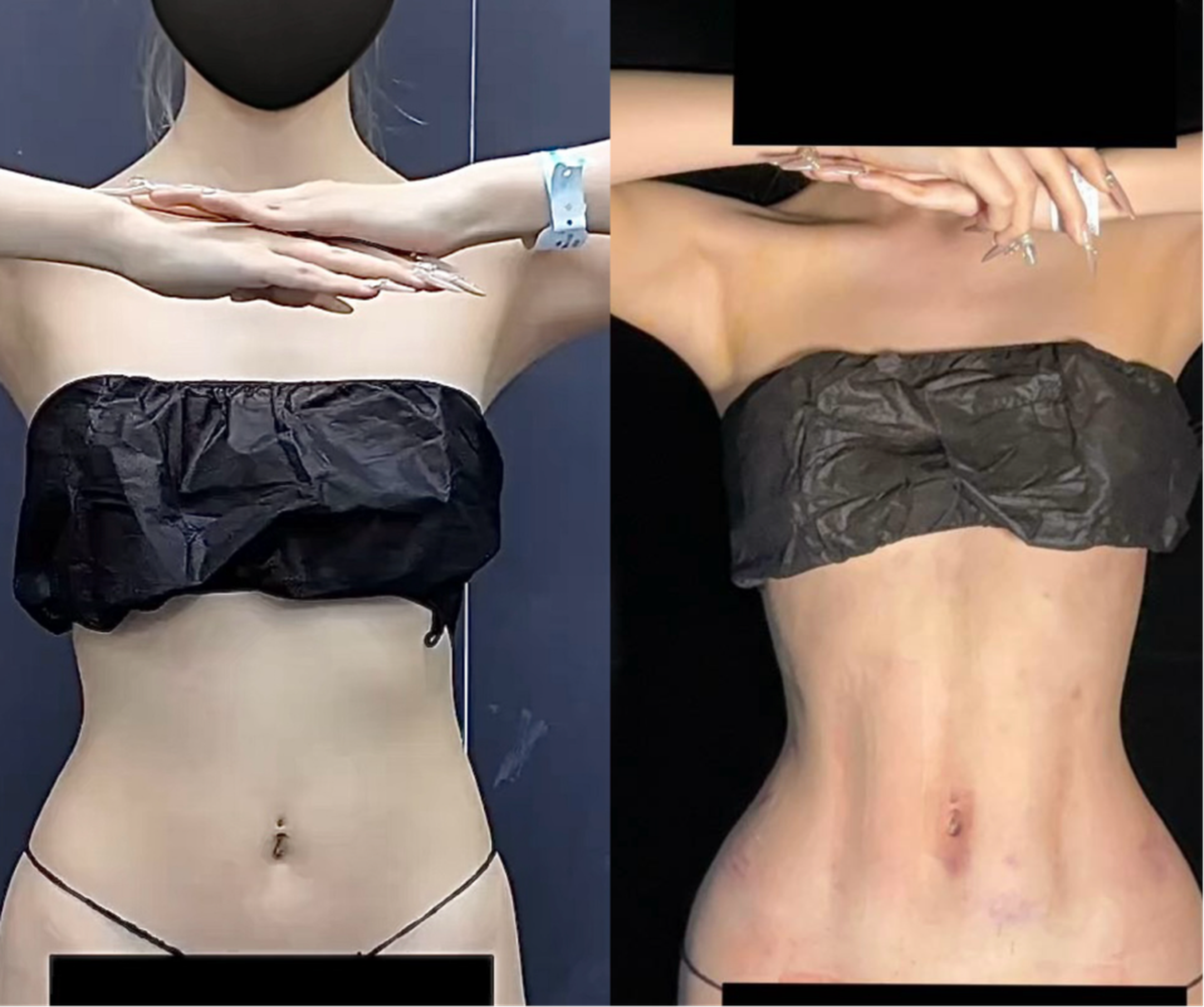 Waist and abdominal liposuction case 2 before and after middle view