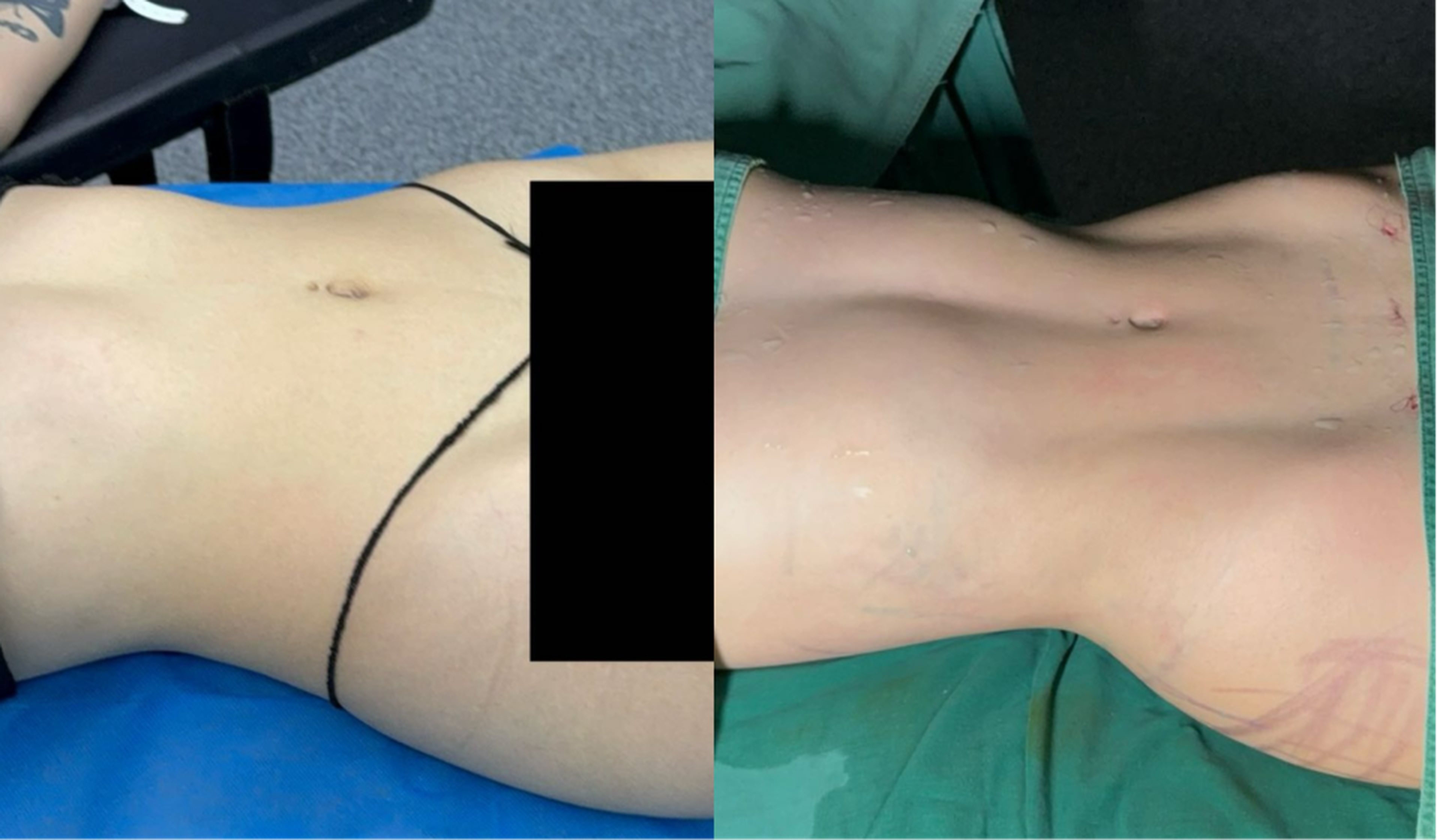 Waist and abdominal liposuction case 2 before and after top view