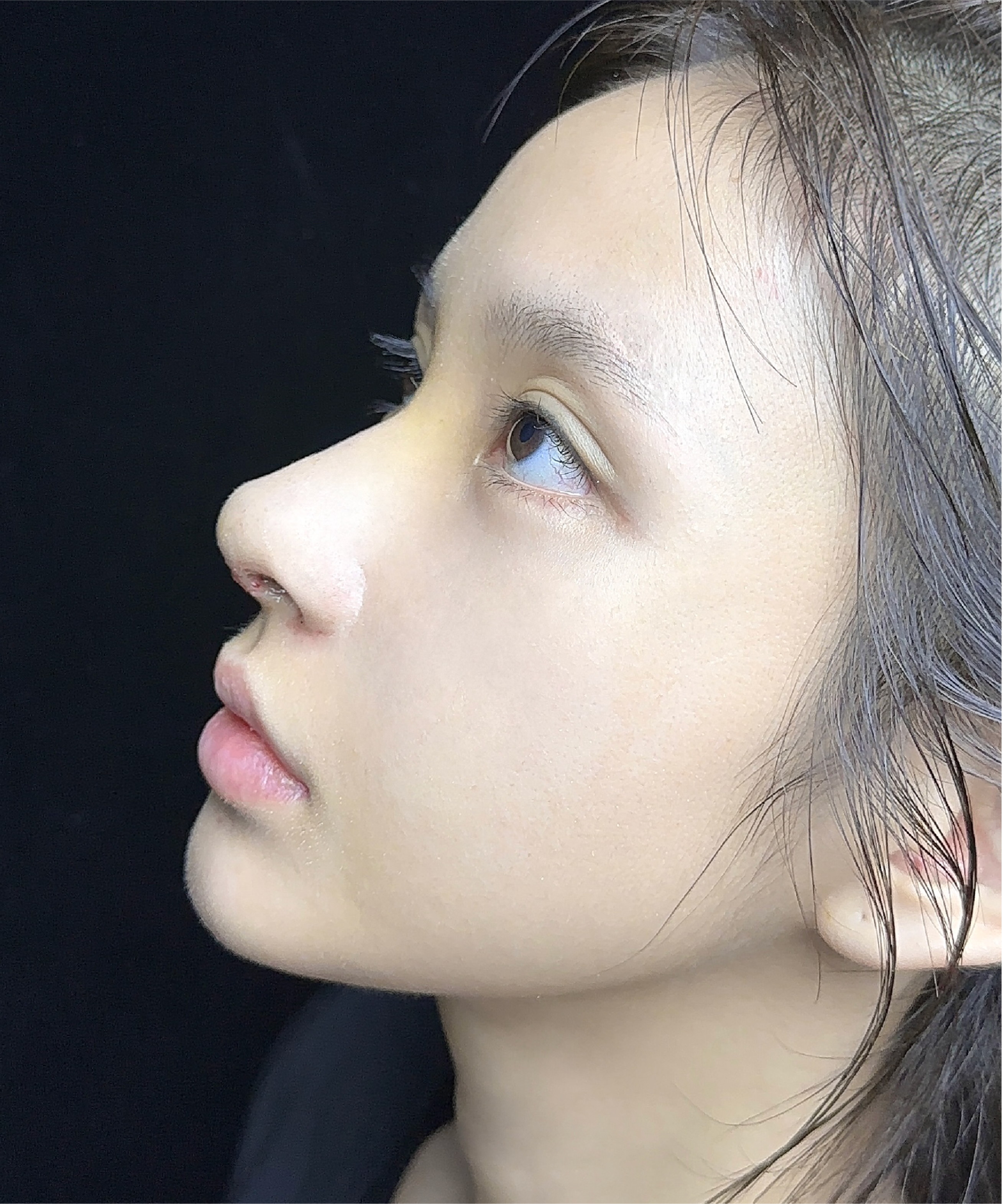 Nose Surgery before